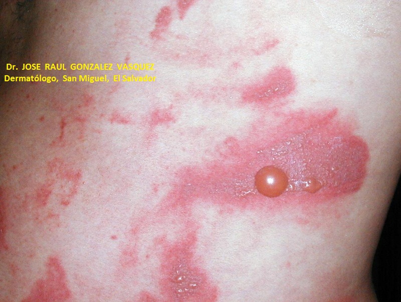 FOTOXICIDAD - FUROCUMARINAS