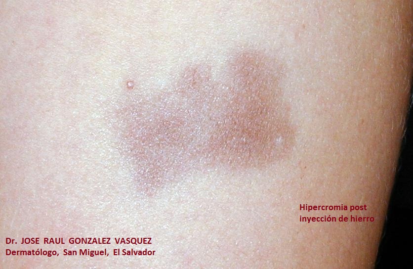 HIPERCROMIA - HIERRO INTRAMUSCULAR