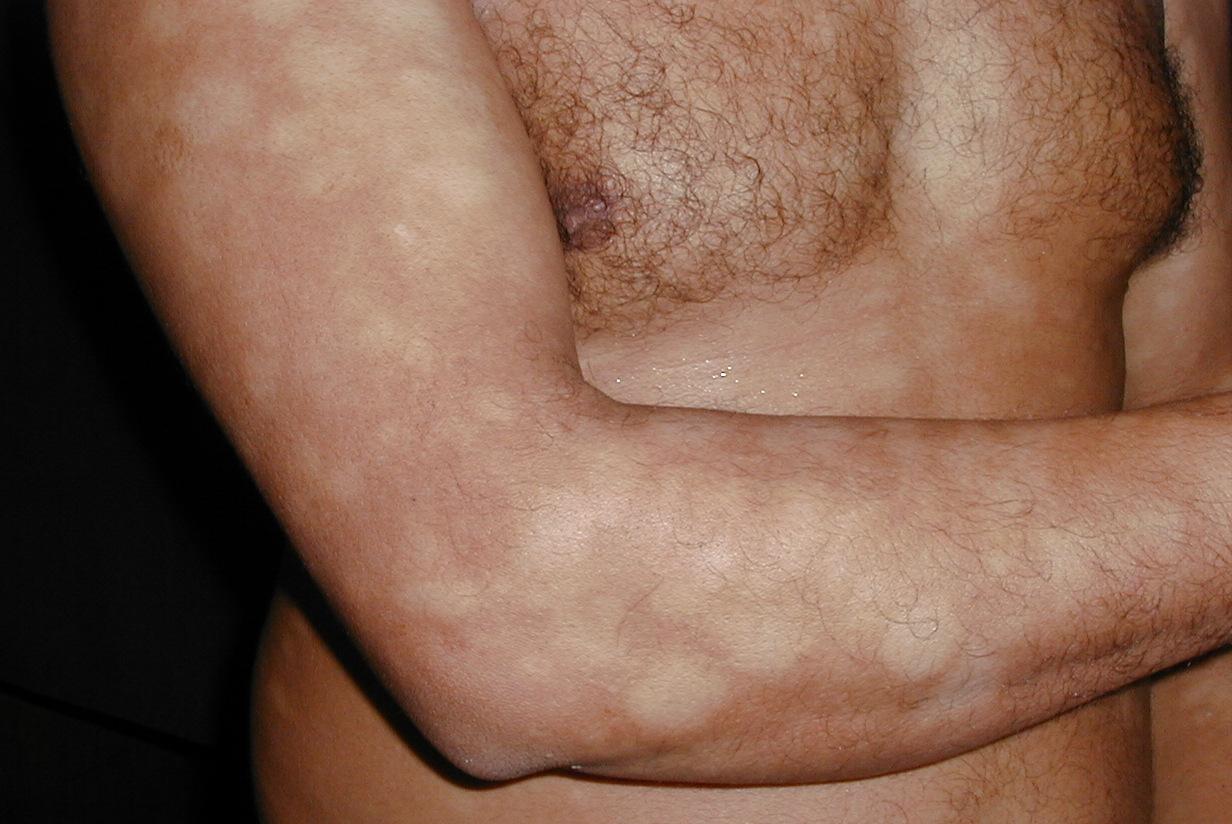 HIPOCROMIA POST-LESIONAL