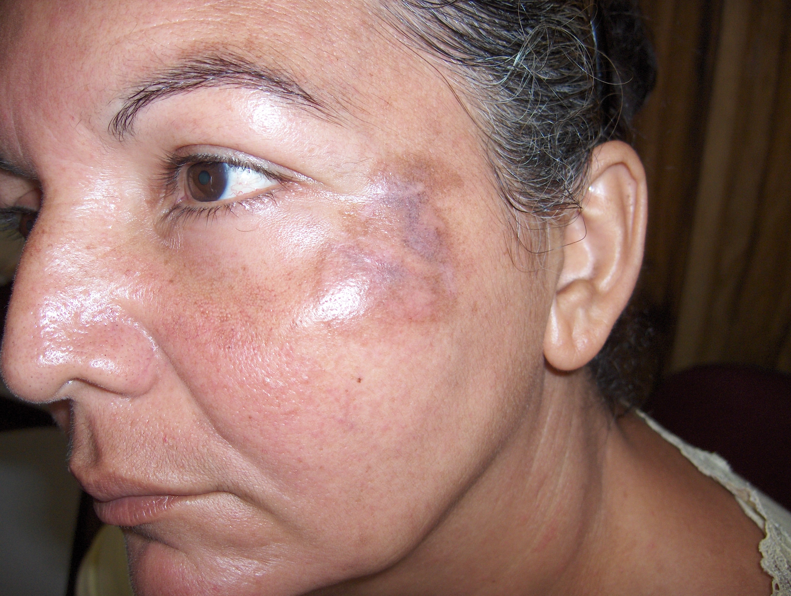 OCRONOSIS - HIDROQUINONA