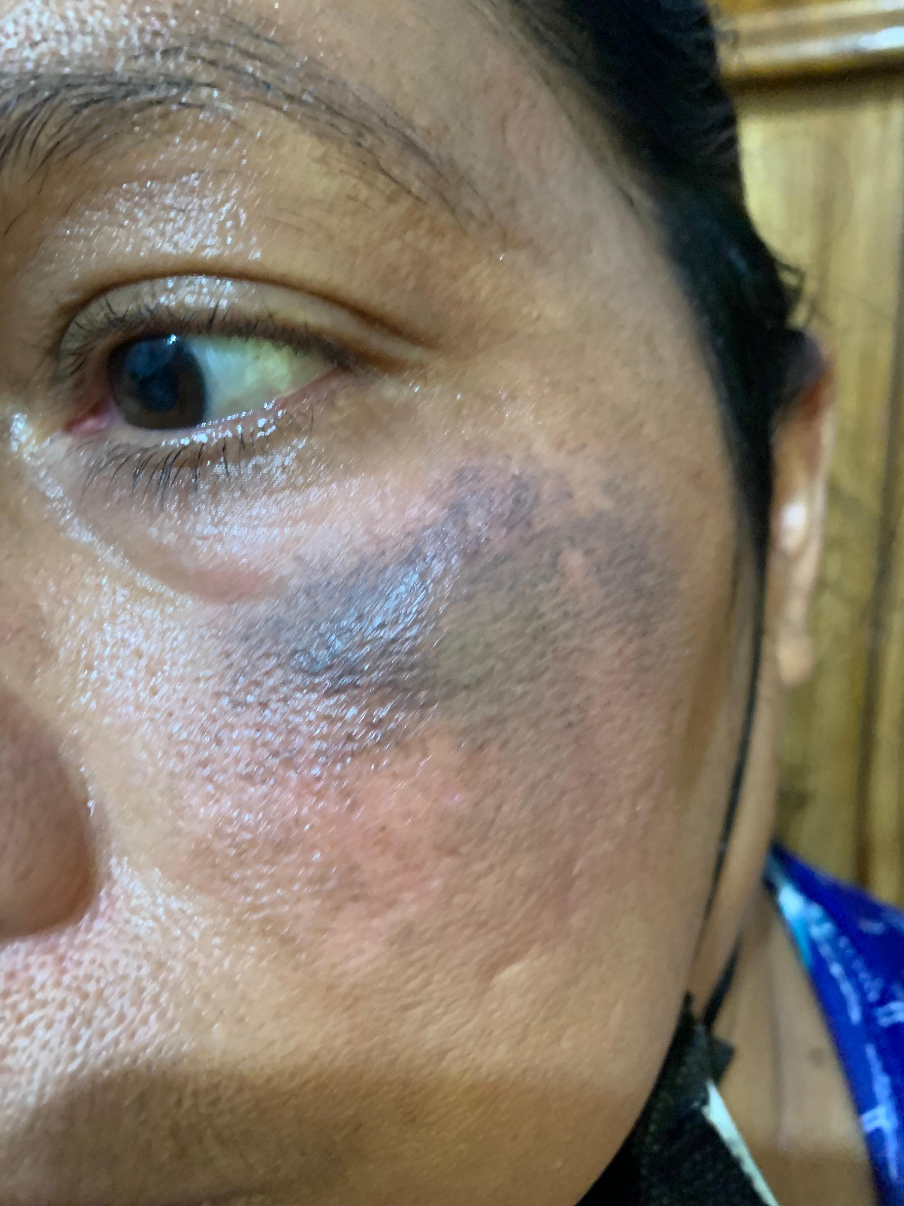 OCRONOSIS - HIDROQUINONA