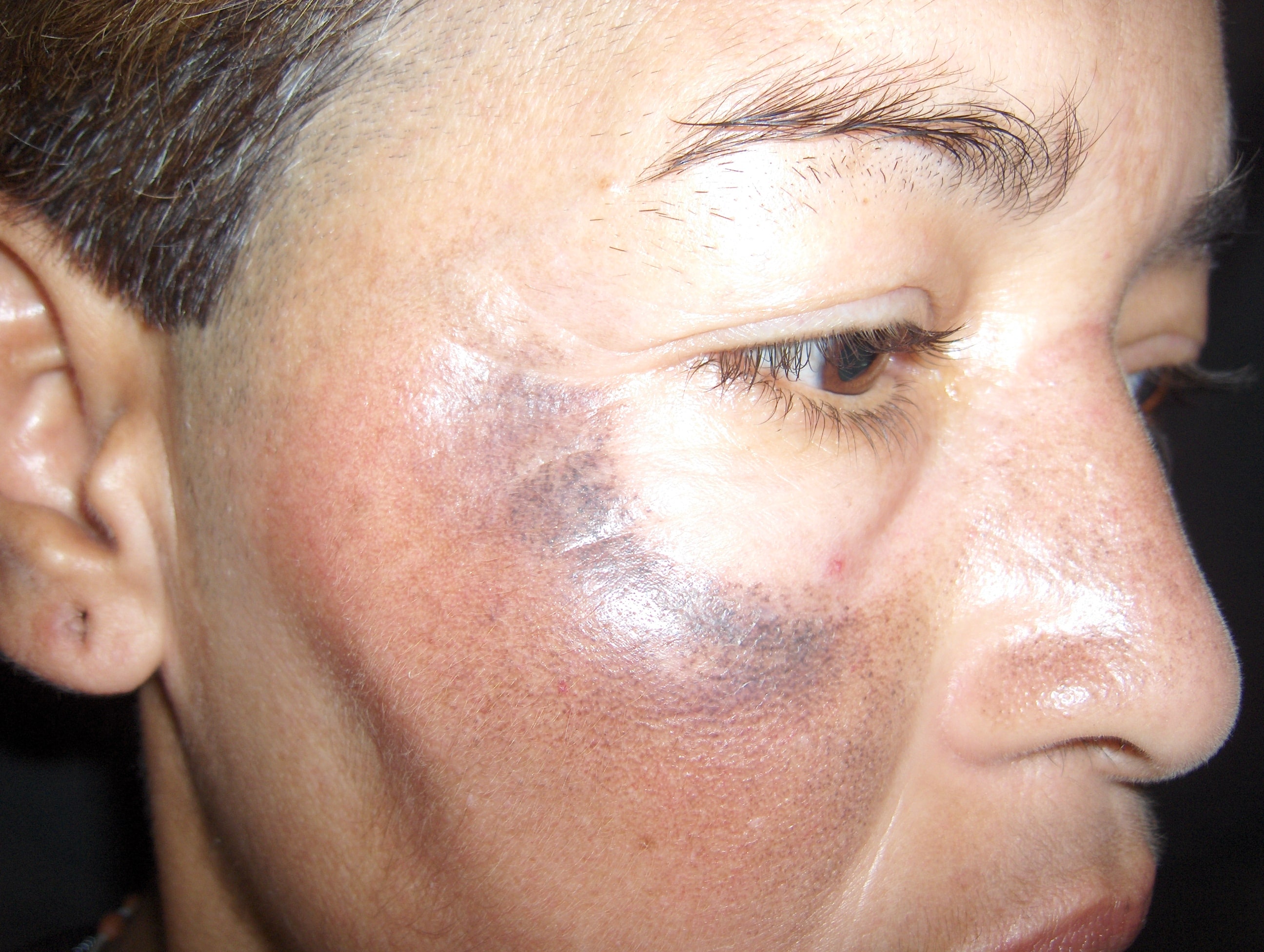 OCRONOSIS - HIDROQUINONA