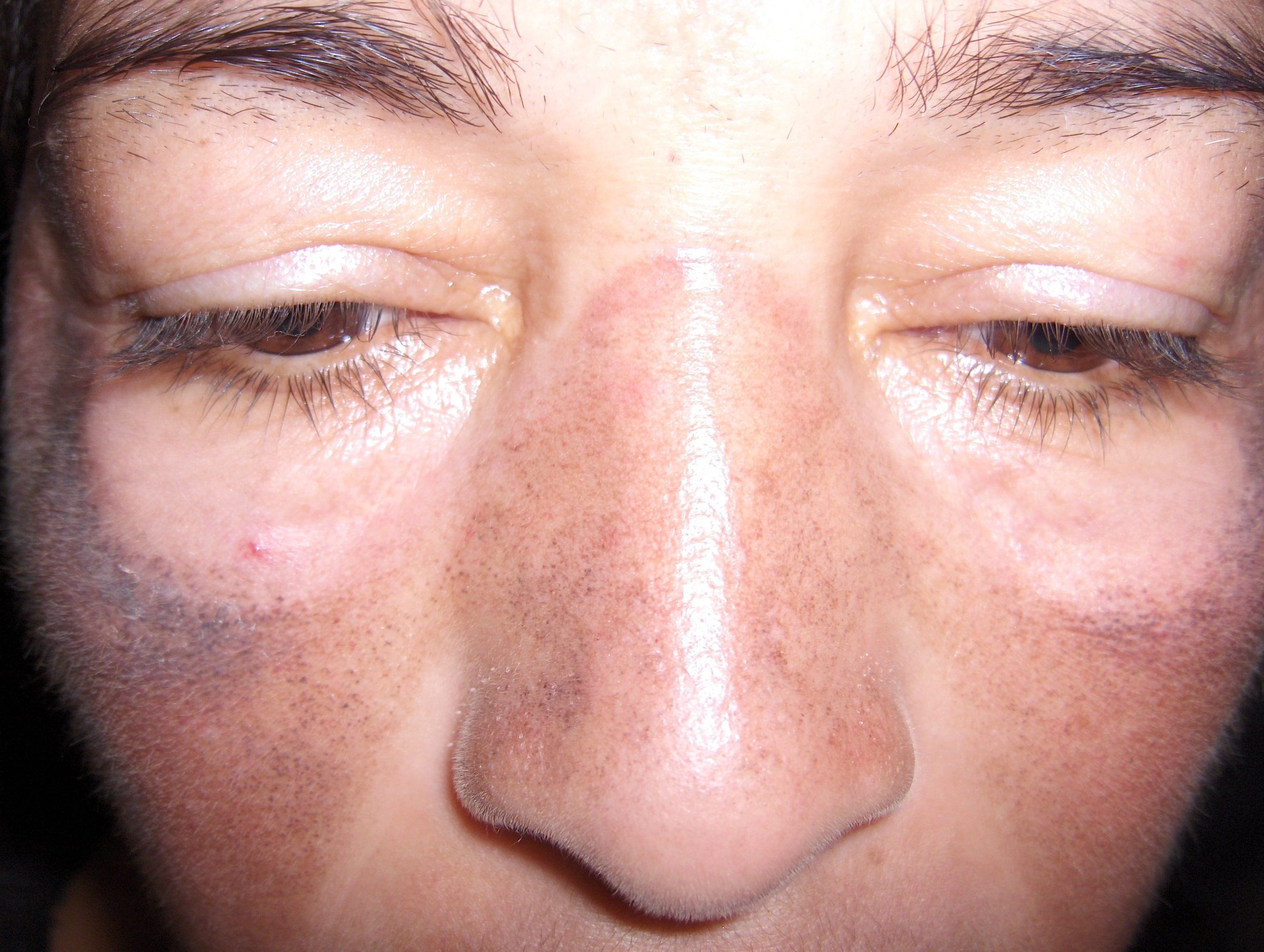 OCRONOSIS - HIDROQUINONA