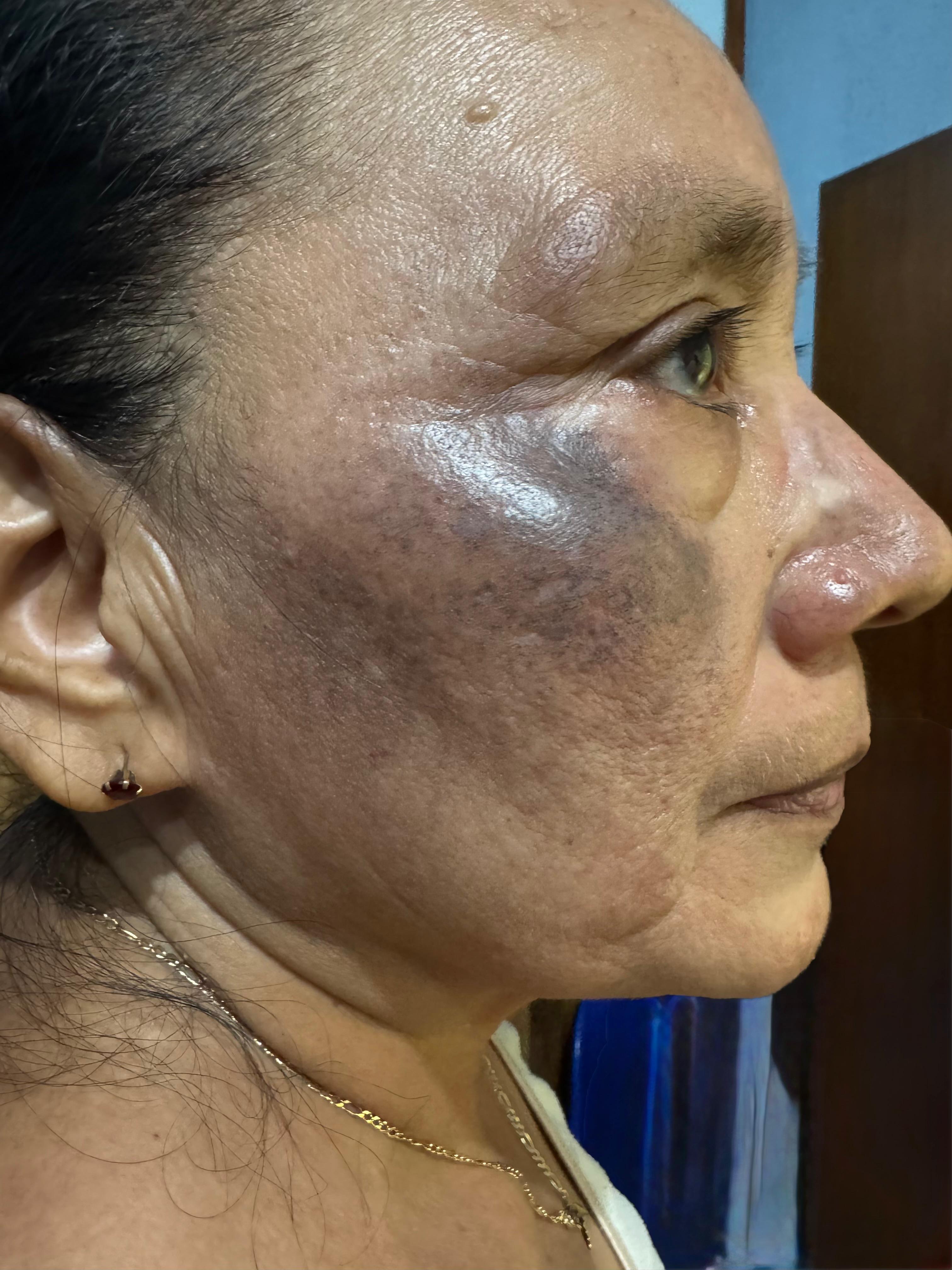 OCRONOSIS - HIDROQUINONA