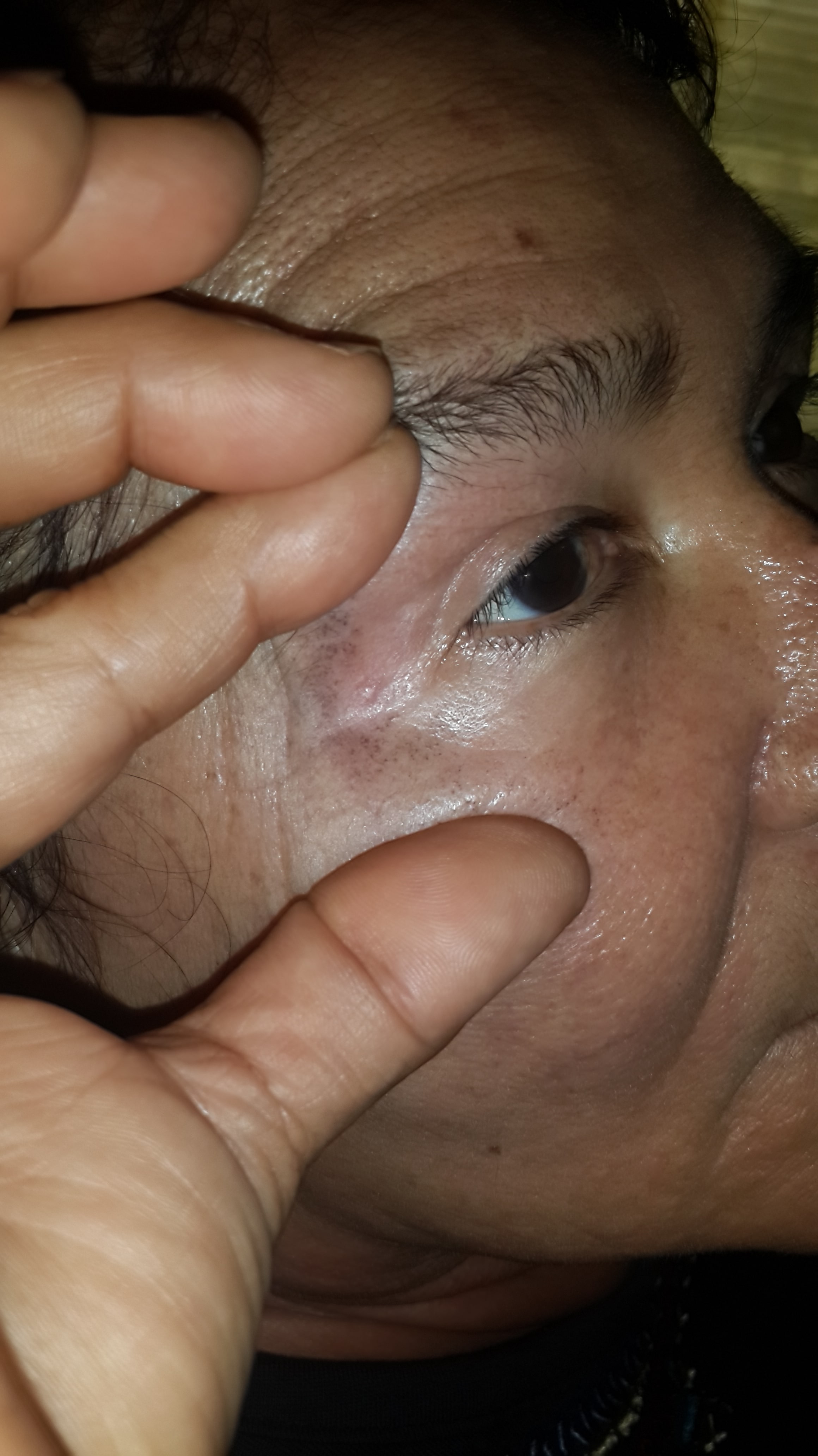 OCRONOSIS - HIDROQUINONA