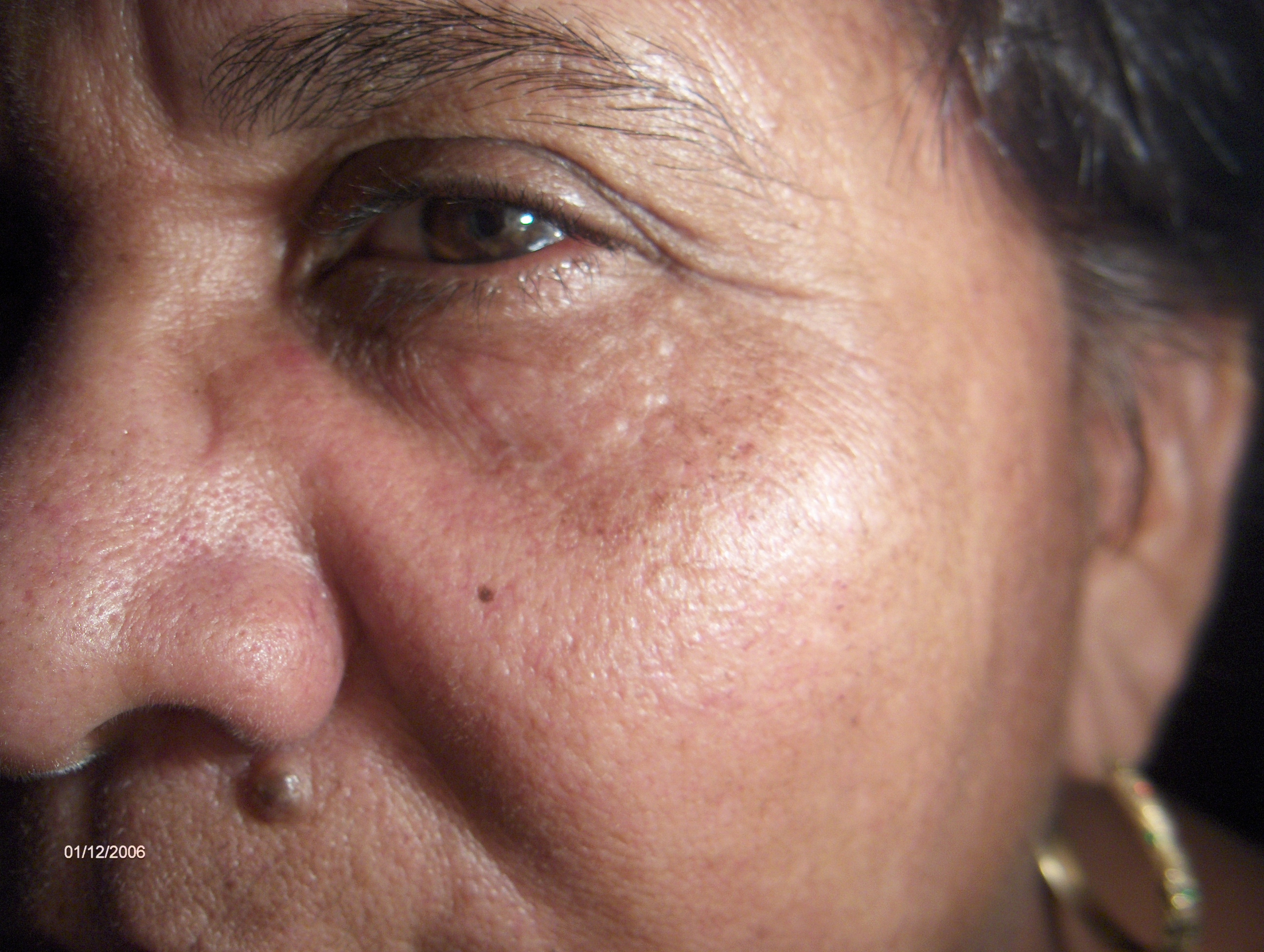 OCRONOSIS y SIRINGOMAS