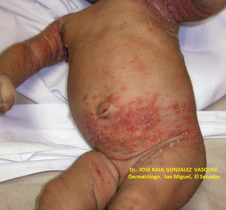 ESCABIASIS - IMPETIGO