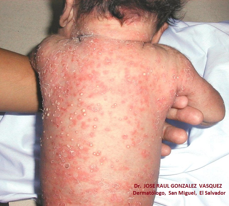 ESCABIASIS - IMPETIGO