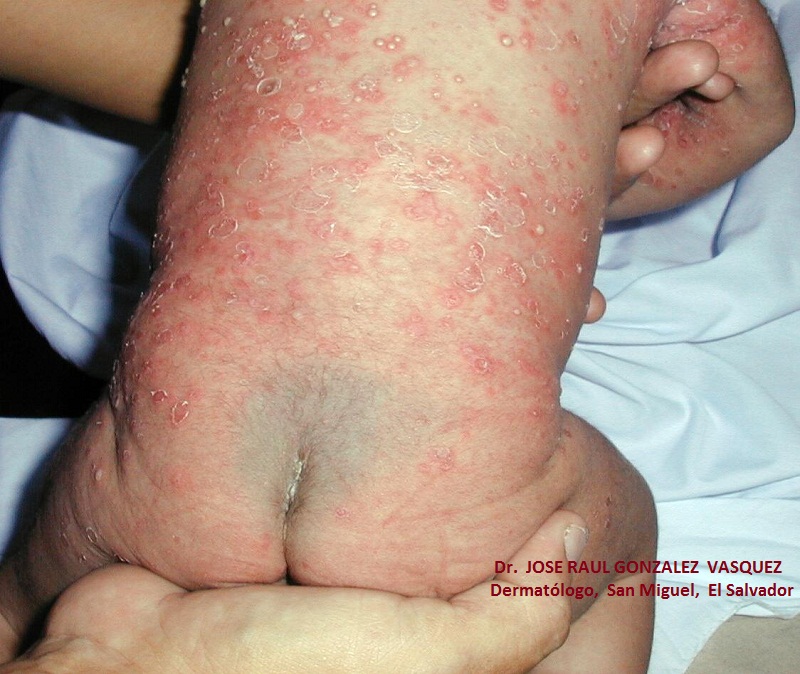 ESCABIASIS - IMPETIGO