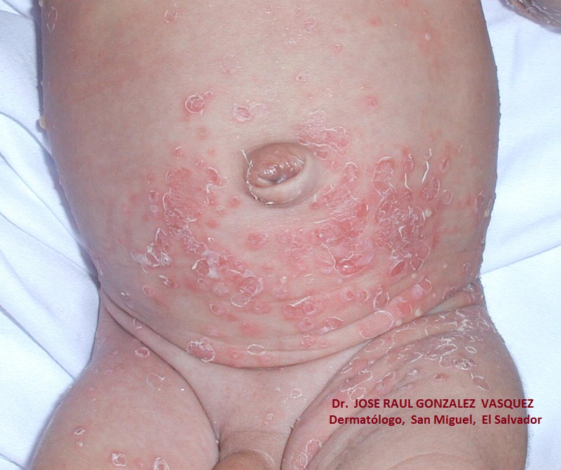 ESCABIASIS - IMPETIGO