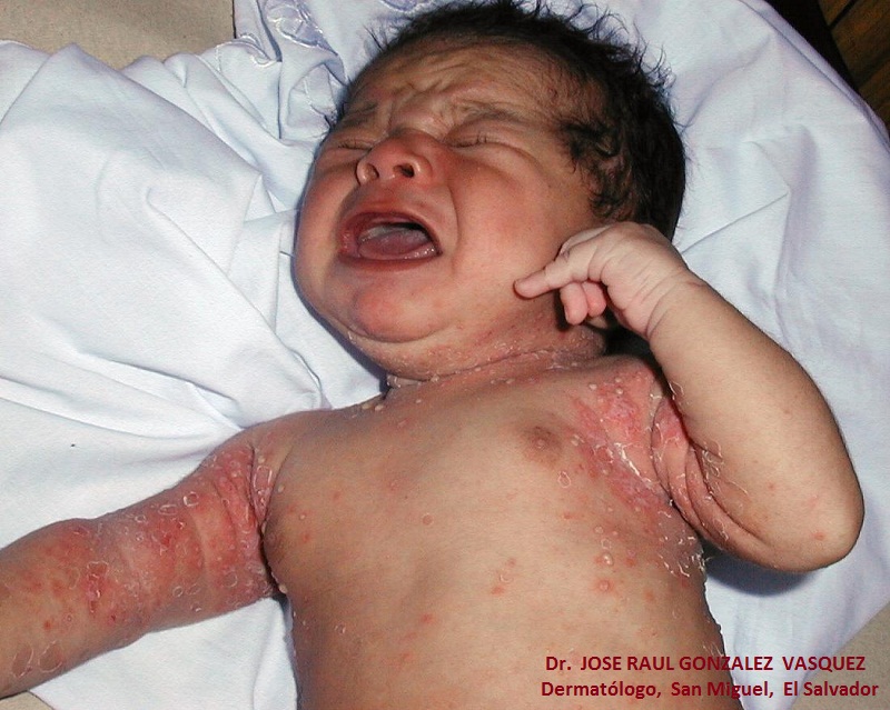 ESCABIASIS - IMPETIGO