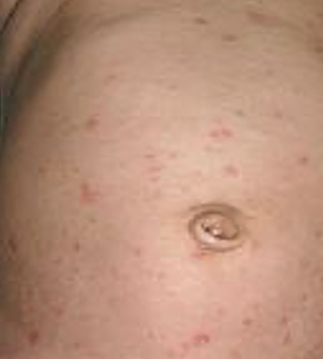 ESCABIASIS EN NIÑOS