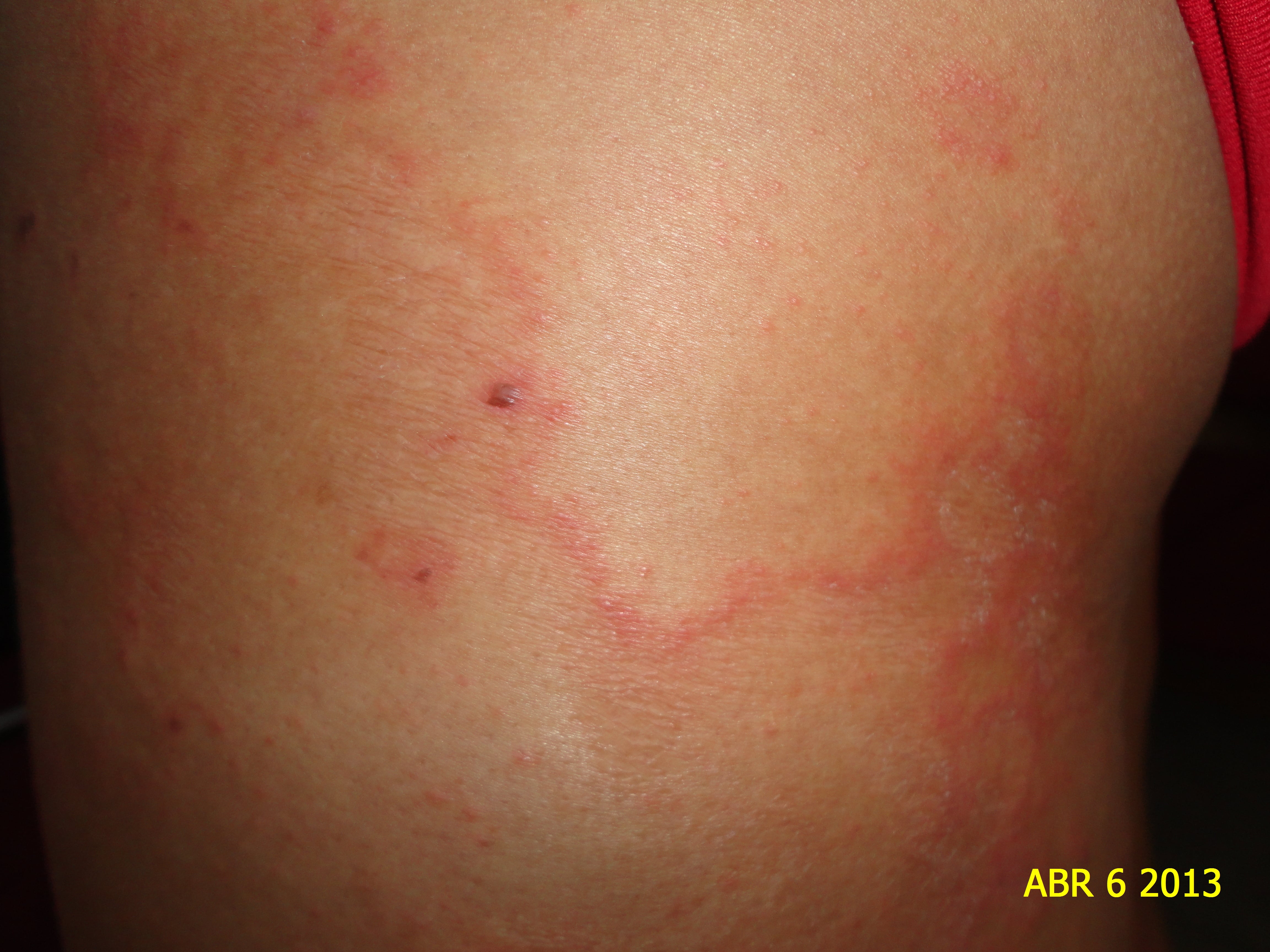 LARVA MIGRANS EN MUSLO