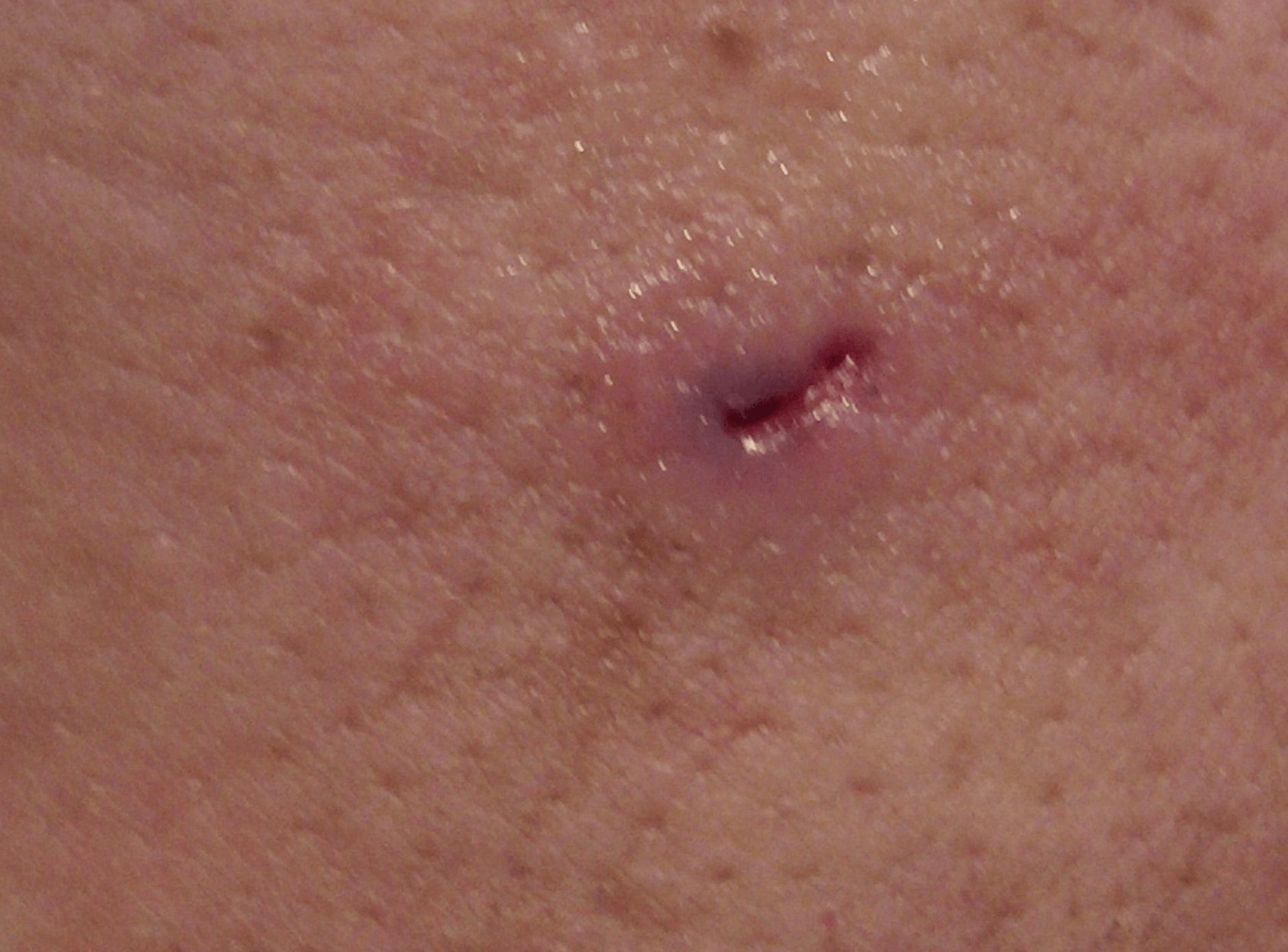 TORSALO - EXTRACCION DE LARVA