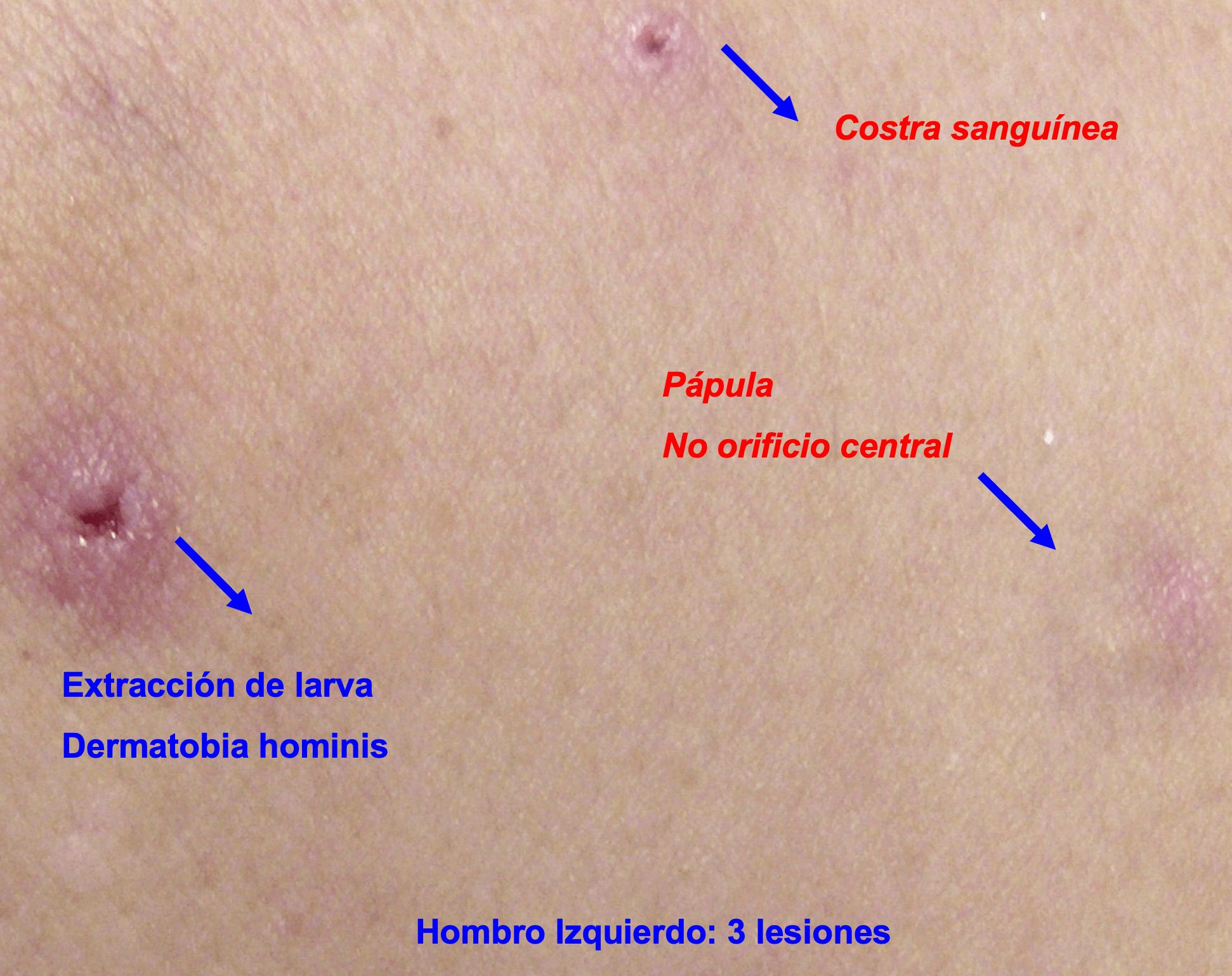 TORSALO - EXTRACCION DE LARVA