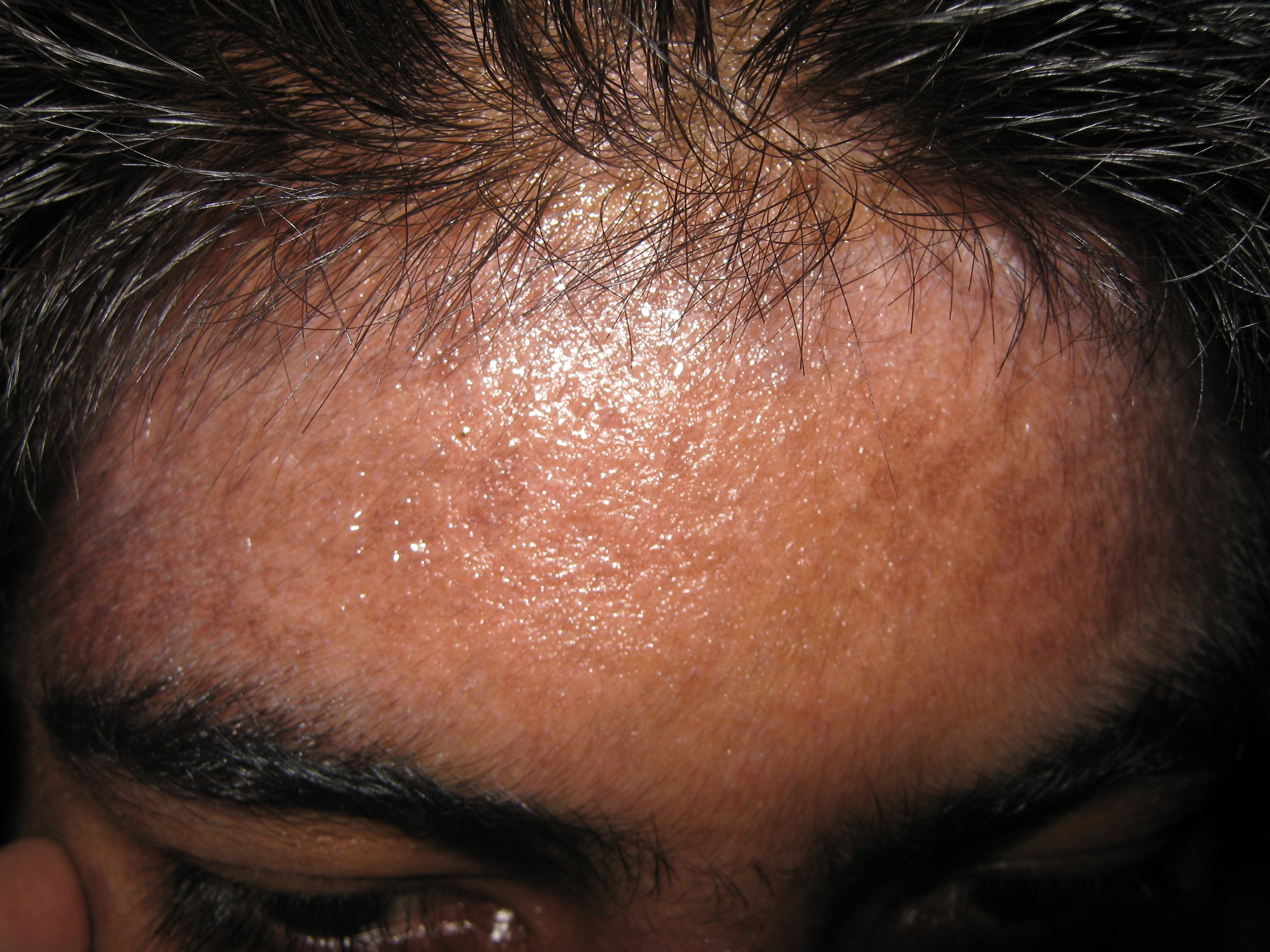 ENFEREMEDAD DE DARIER