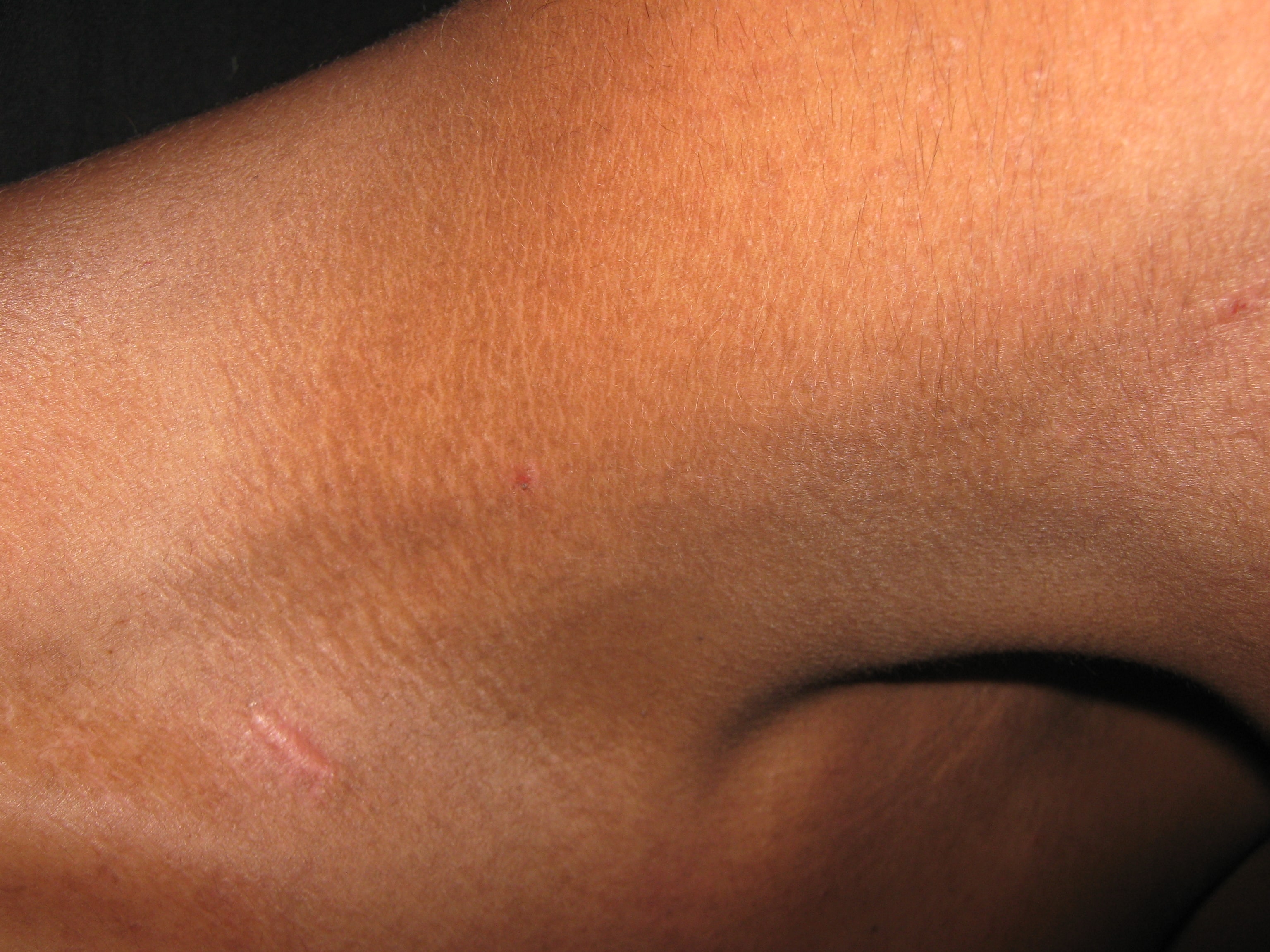 ENFEREMEDAD DE DARIER