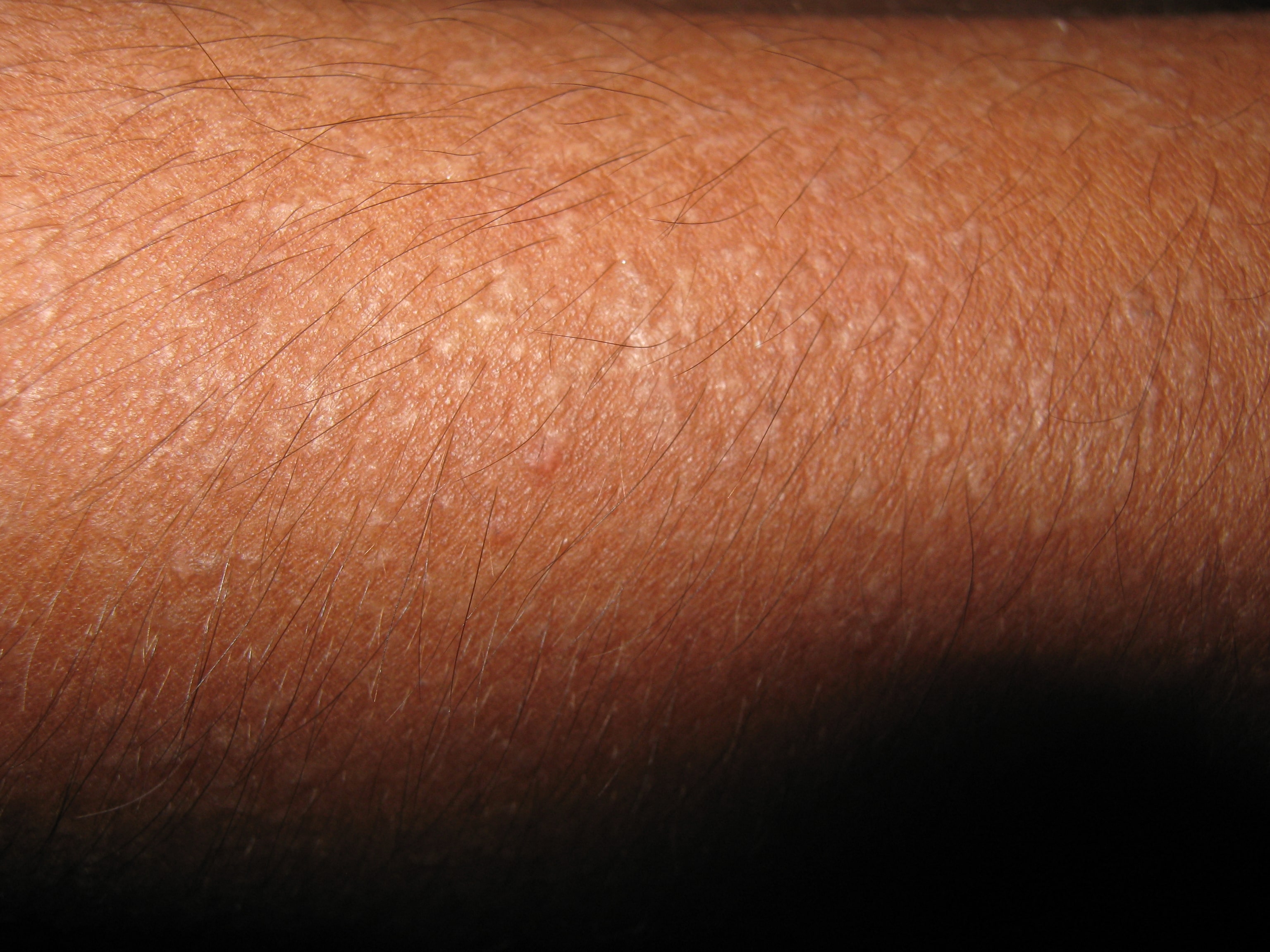 ENFEREMEDAD DE DARIER