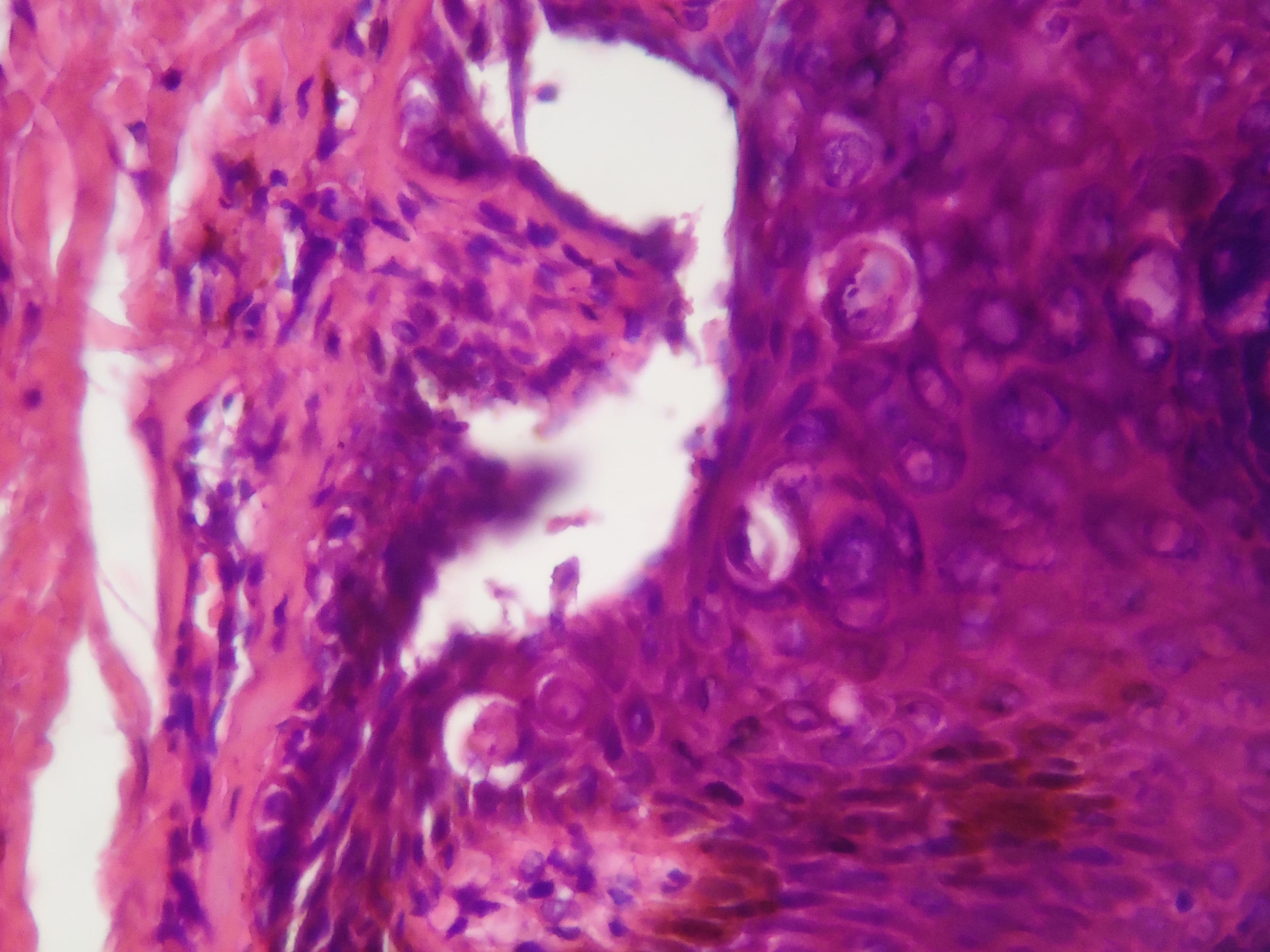 ENFEREMEDAD DE DARIER - HISTOPATOLOGIA