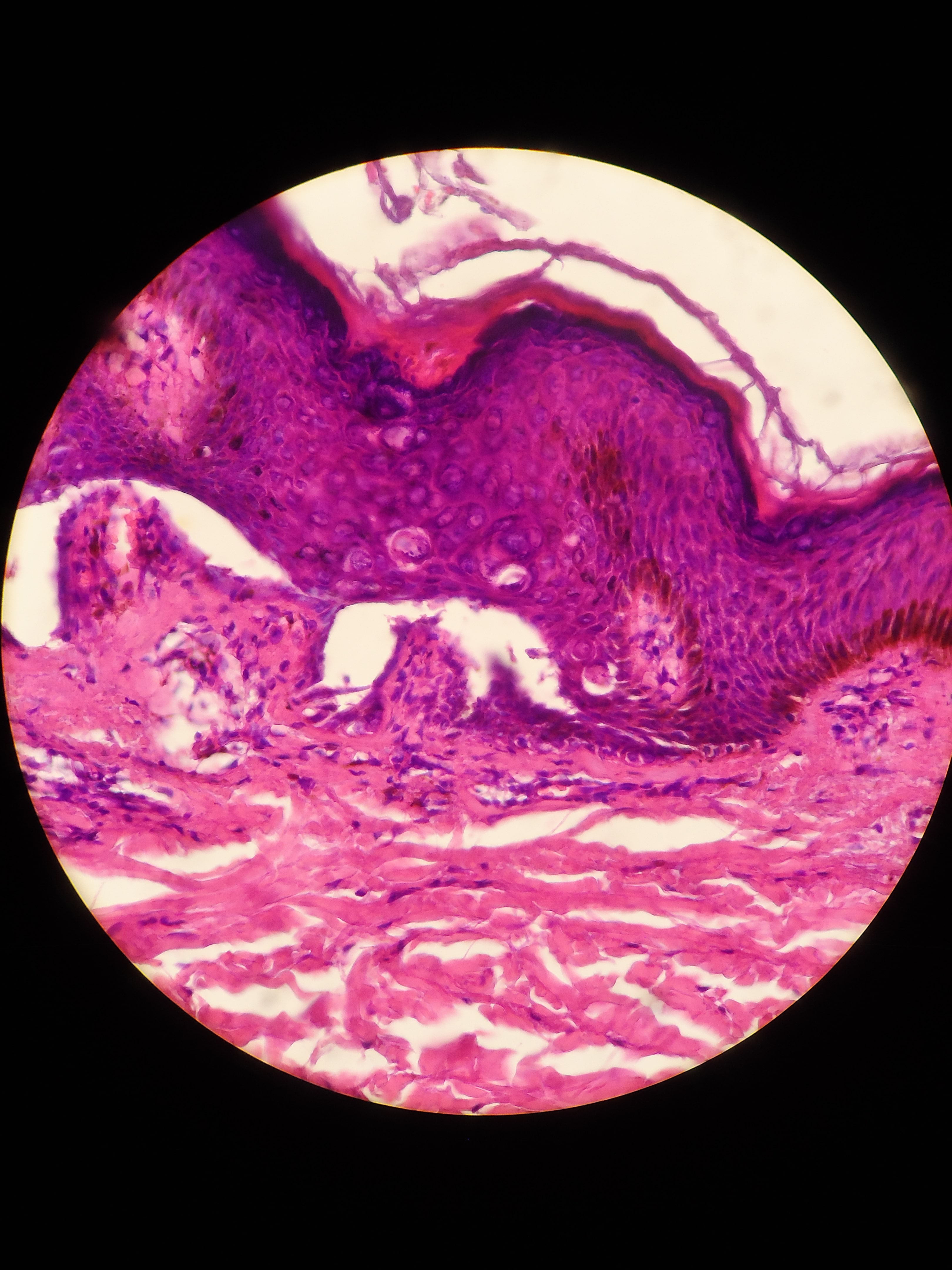 ENFEREMEDAD DE DARIER - HISTOPATOLOGIA