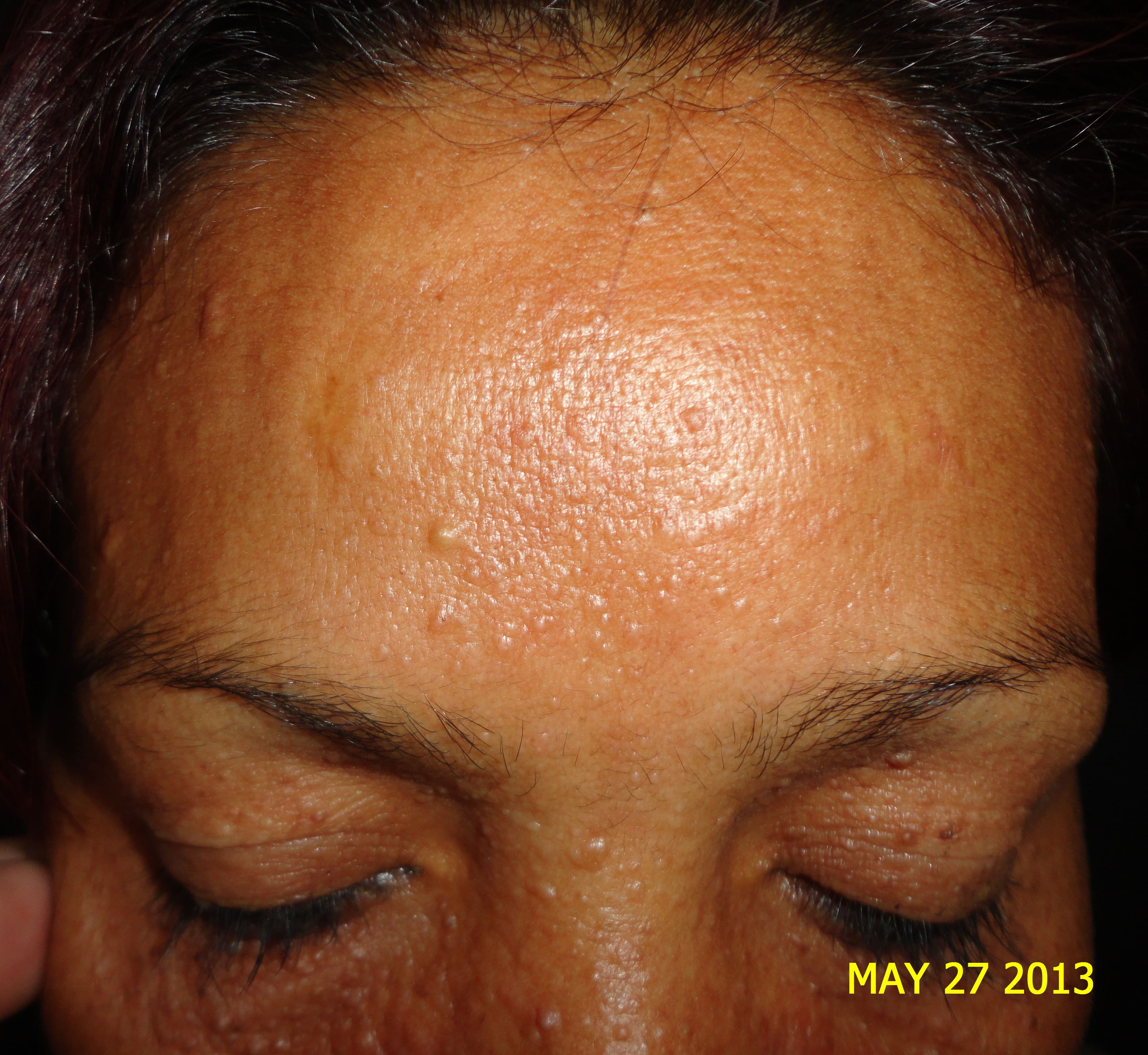 ESCLEROSIS TUBEROSA - ANGIOFIBROMAS