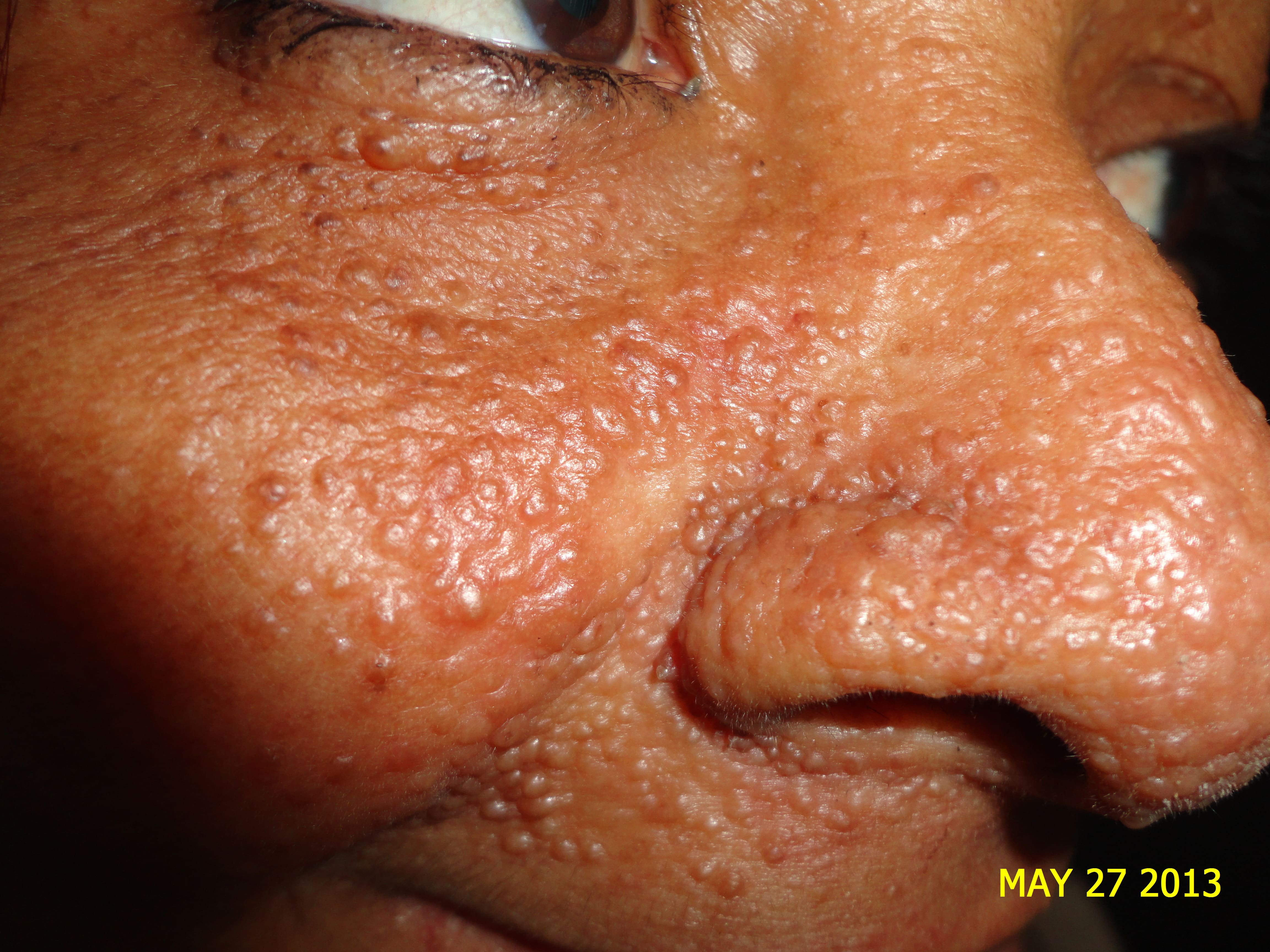 ESCLEROSIS TUBEROSA - ANGIOFIBROMAS