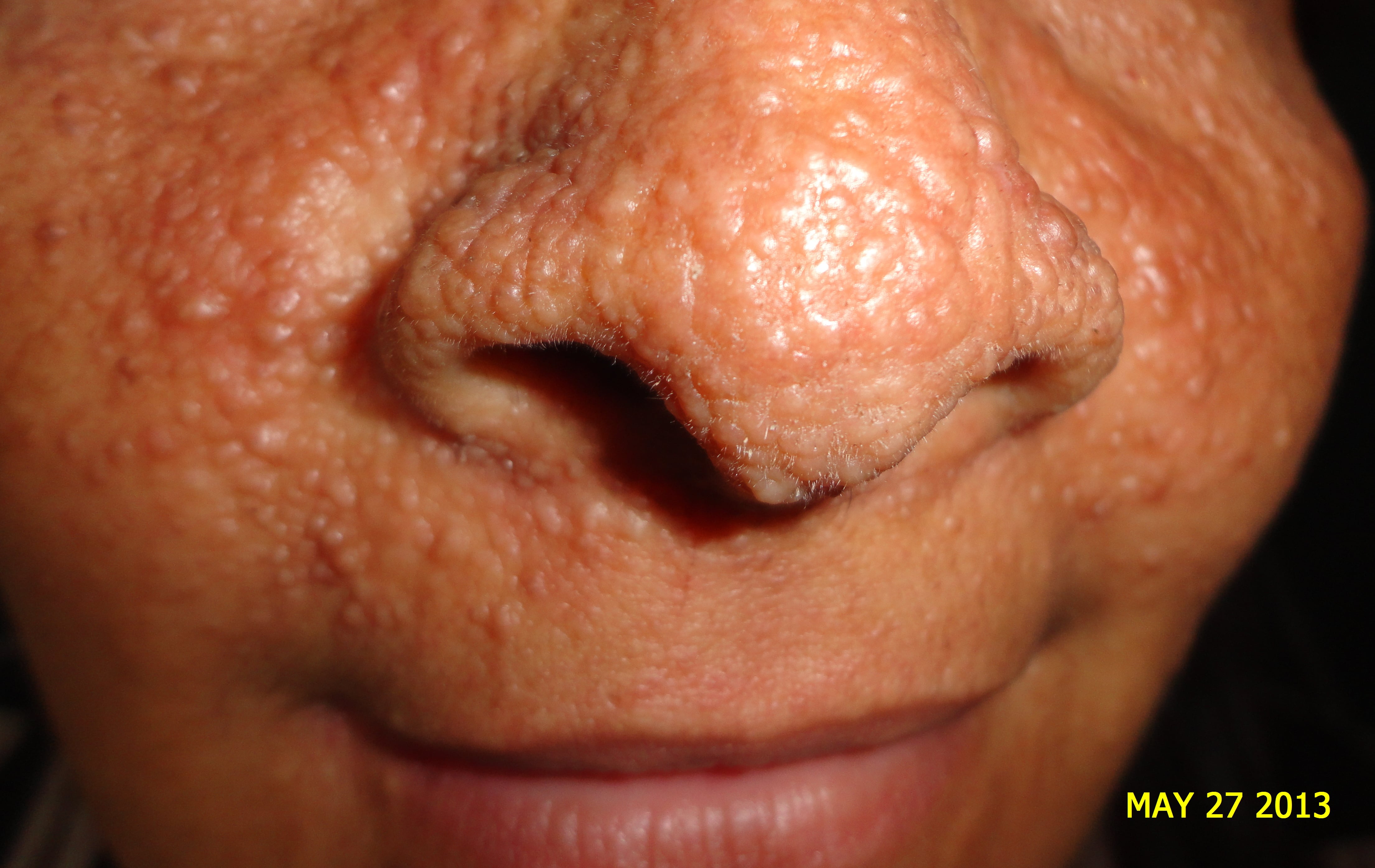 ESCLEROSIS TUBEROSA - ANGIOFIBROMAS