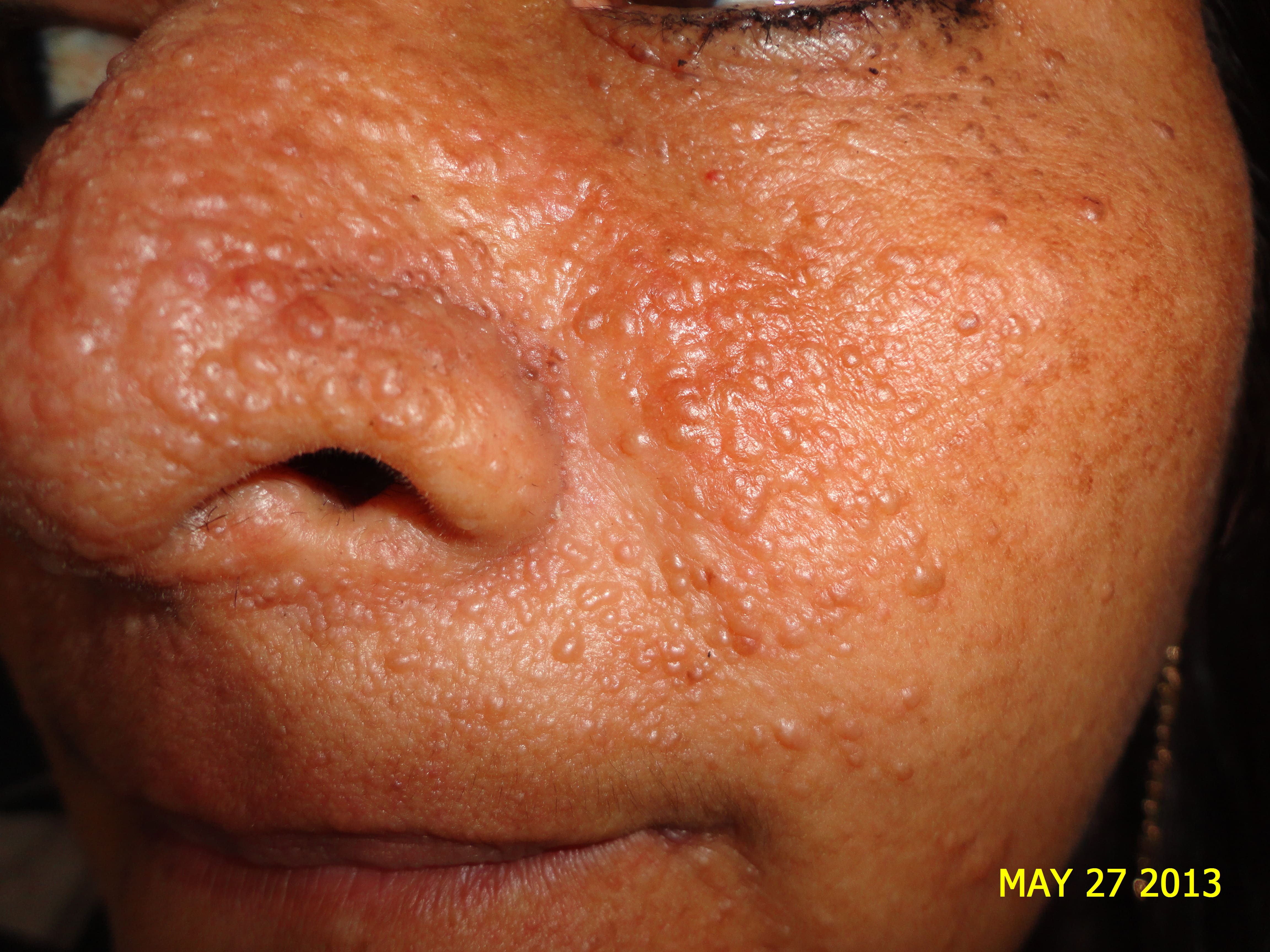 ESCLEROSIS TUBEROSA - ANGIOFIBROMAS