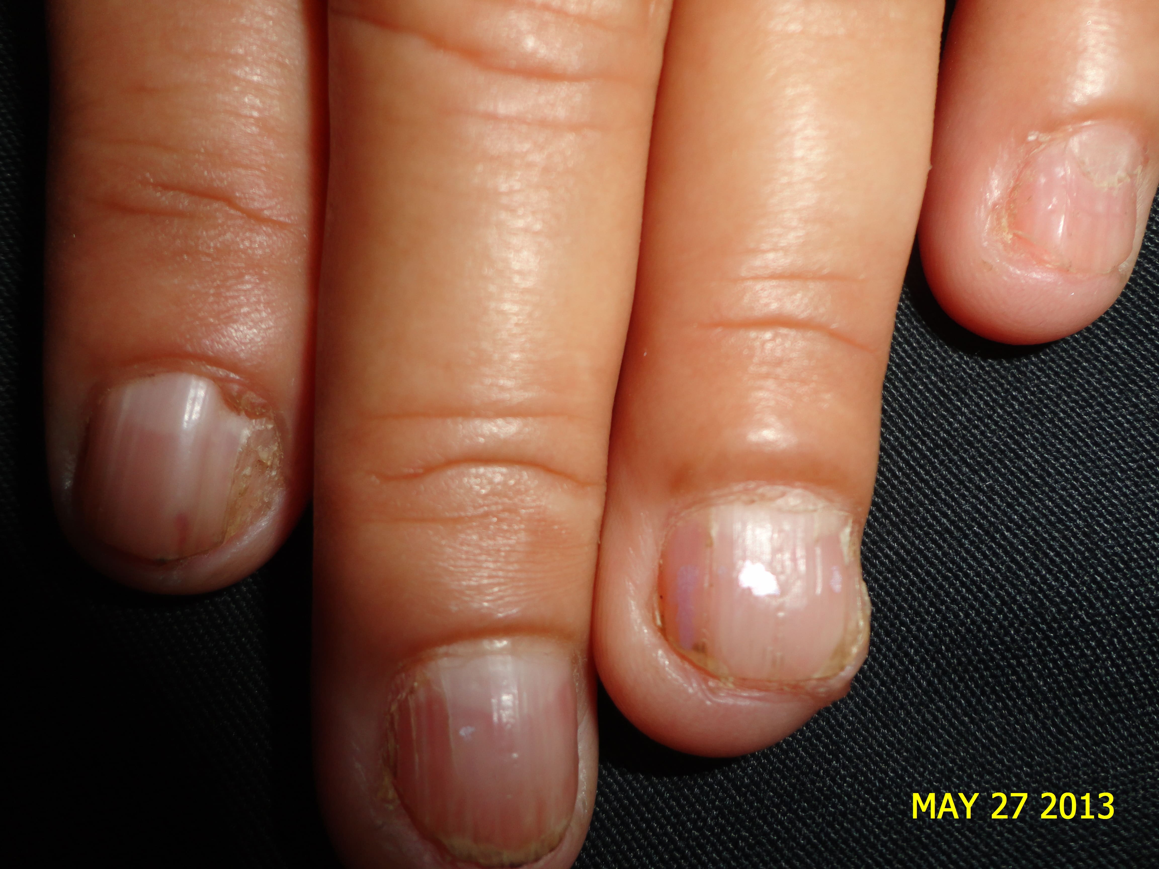 ESCLEROSIS TUBEROSA - FIBROMAS ó TUMOR DE KOENEN