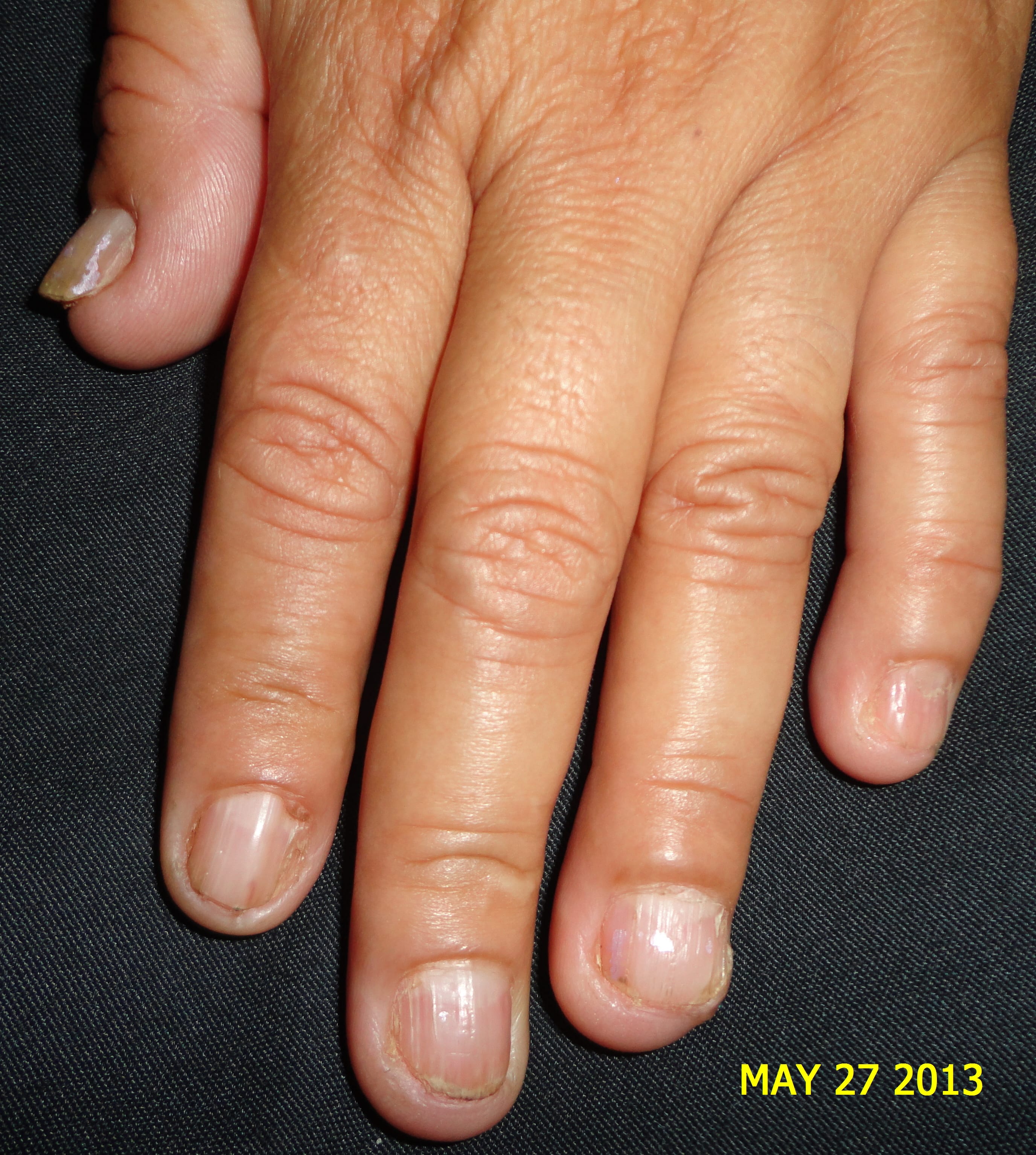 ESCLEROSIS TUBEROSA - FIBROMAS ó TUMOR DE KOENEN