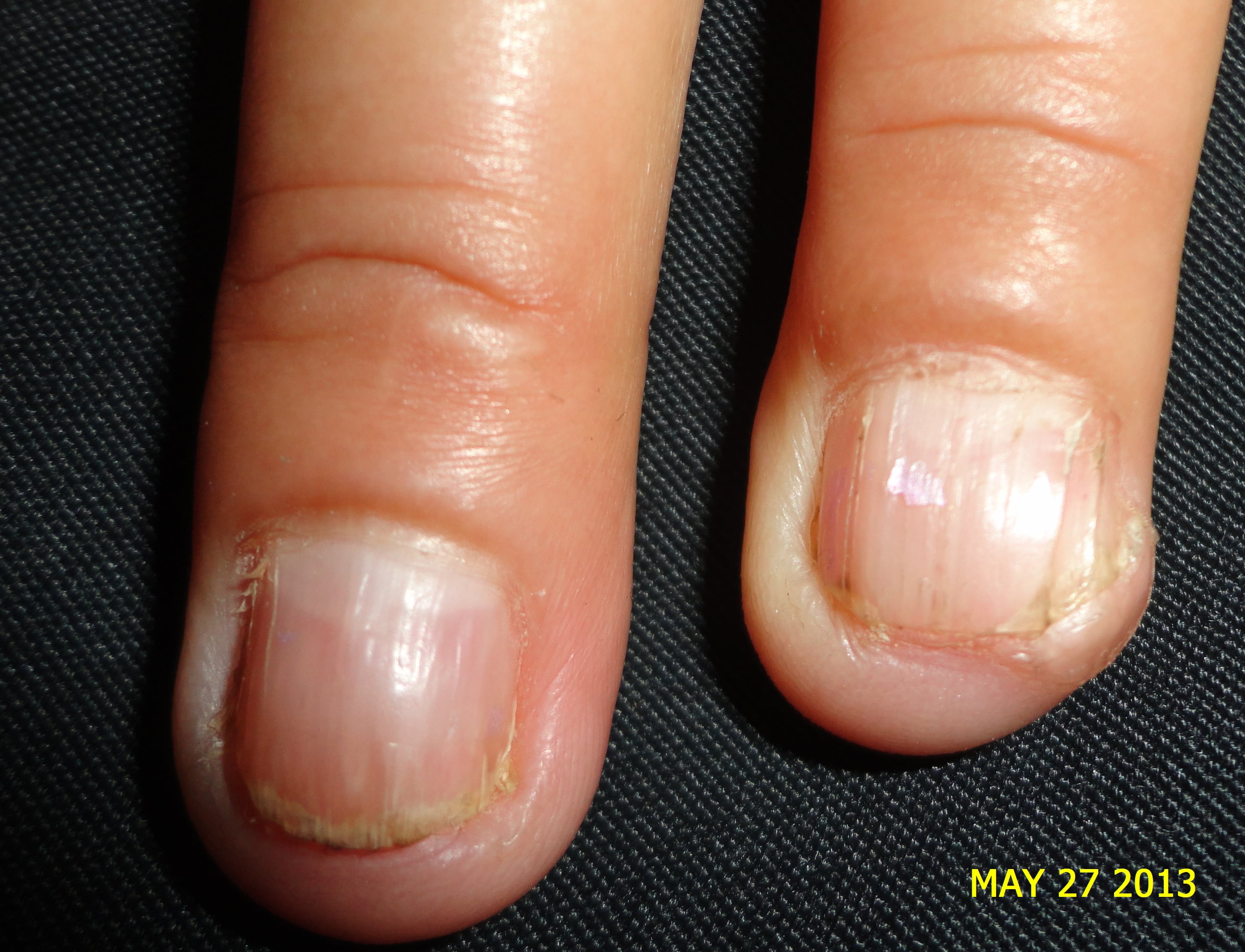 ESCLEROSIS TUBEROSA - FIBROMAS ó TUMOR DE KOENEN