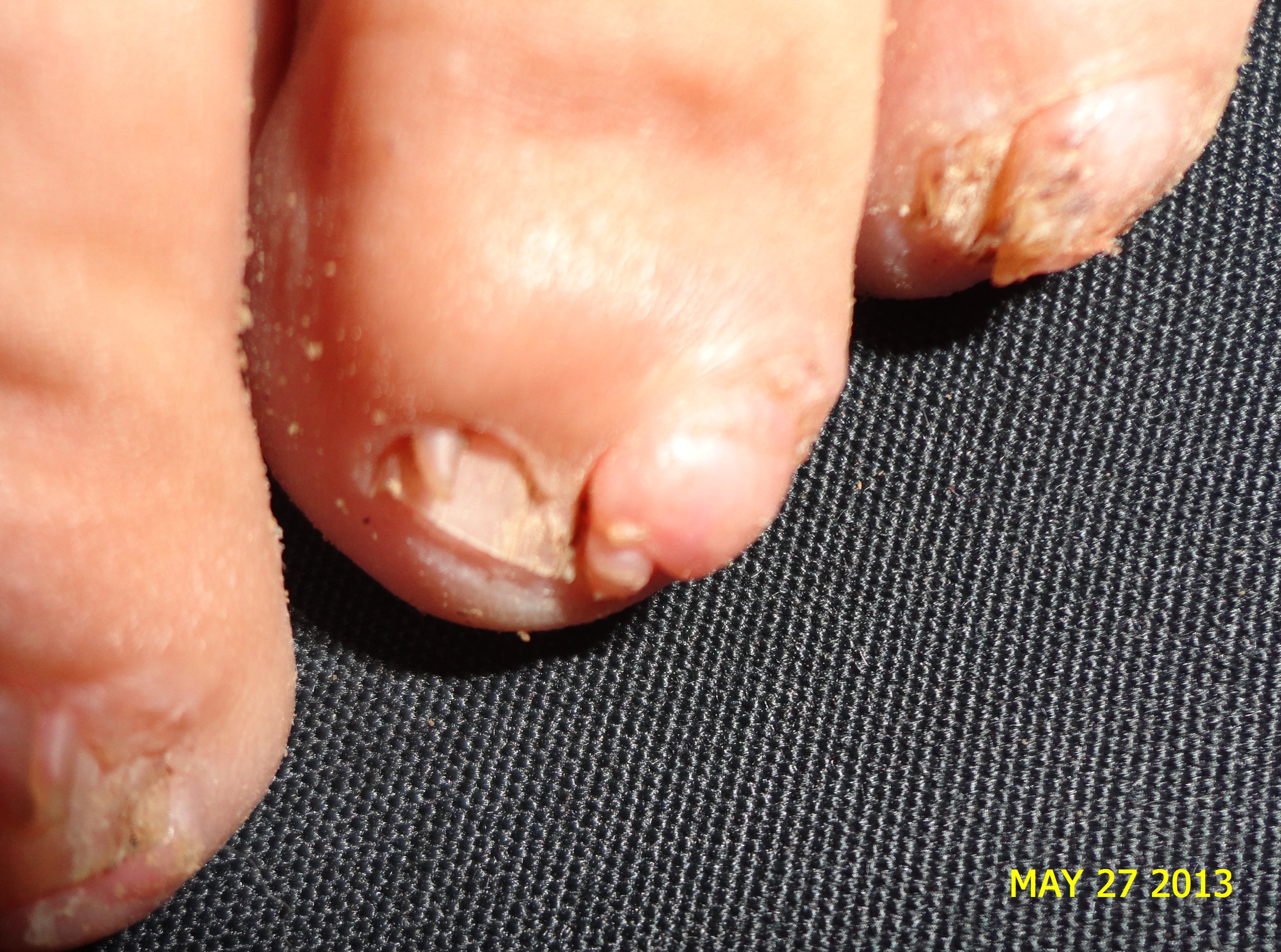 ESCLEROSIS TUBEROSA - FIBROMAS ó TUMOR DE KOENEN