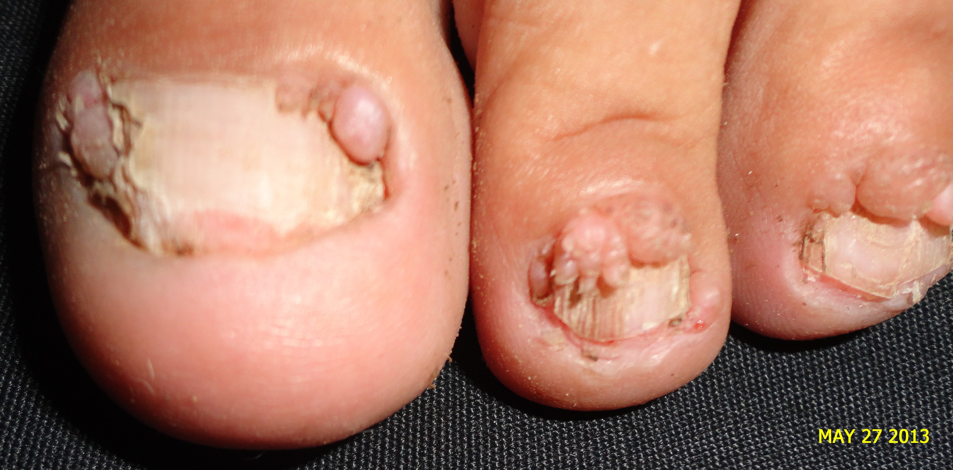 ESCLEROSIS TUBEROSA - FIBROMAS ó TUMOR DE KOENEN