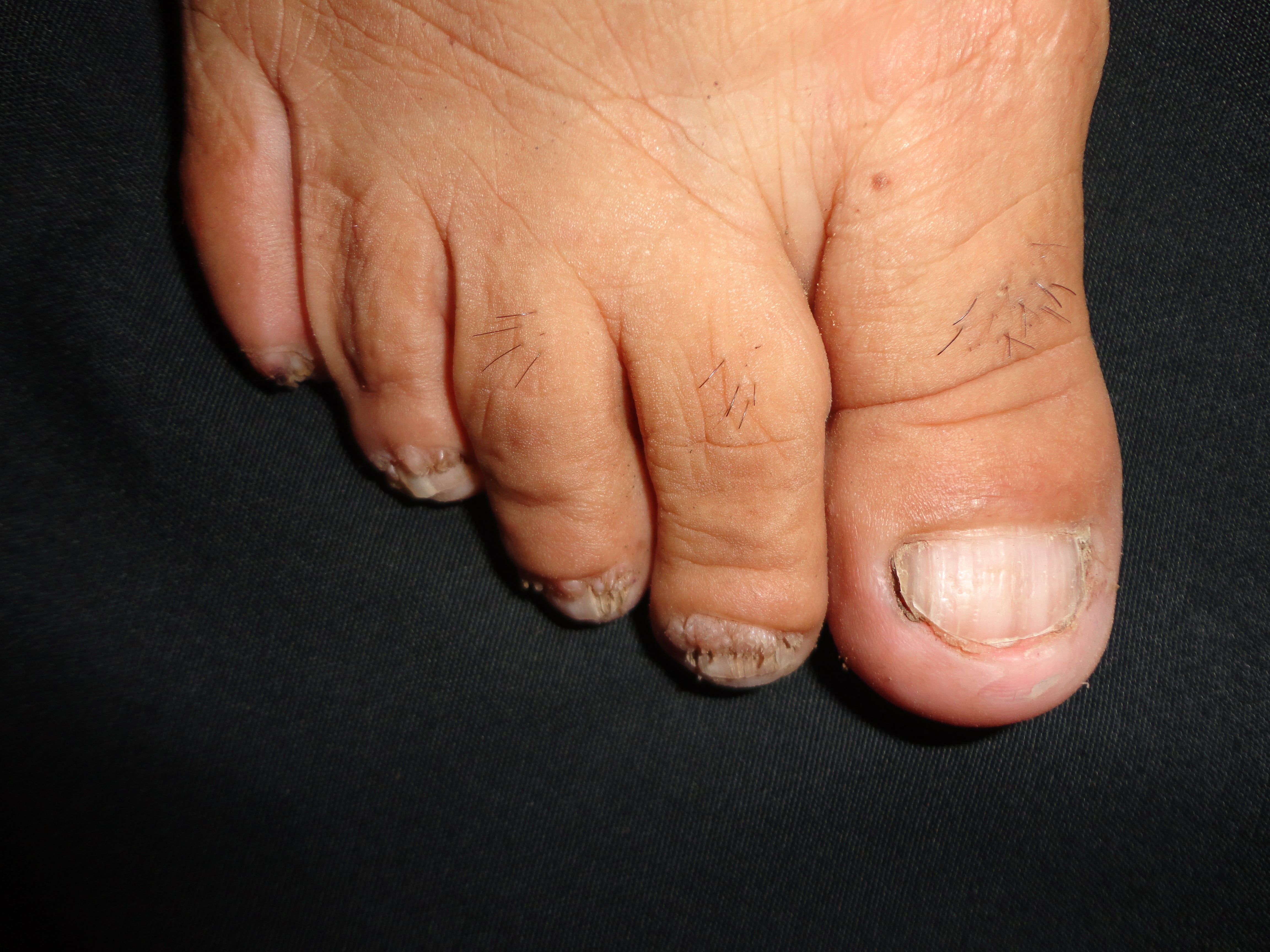 ESCLEROSIS TUBEROSA - FIBROMAS ó TUMOR DE KOENEN