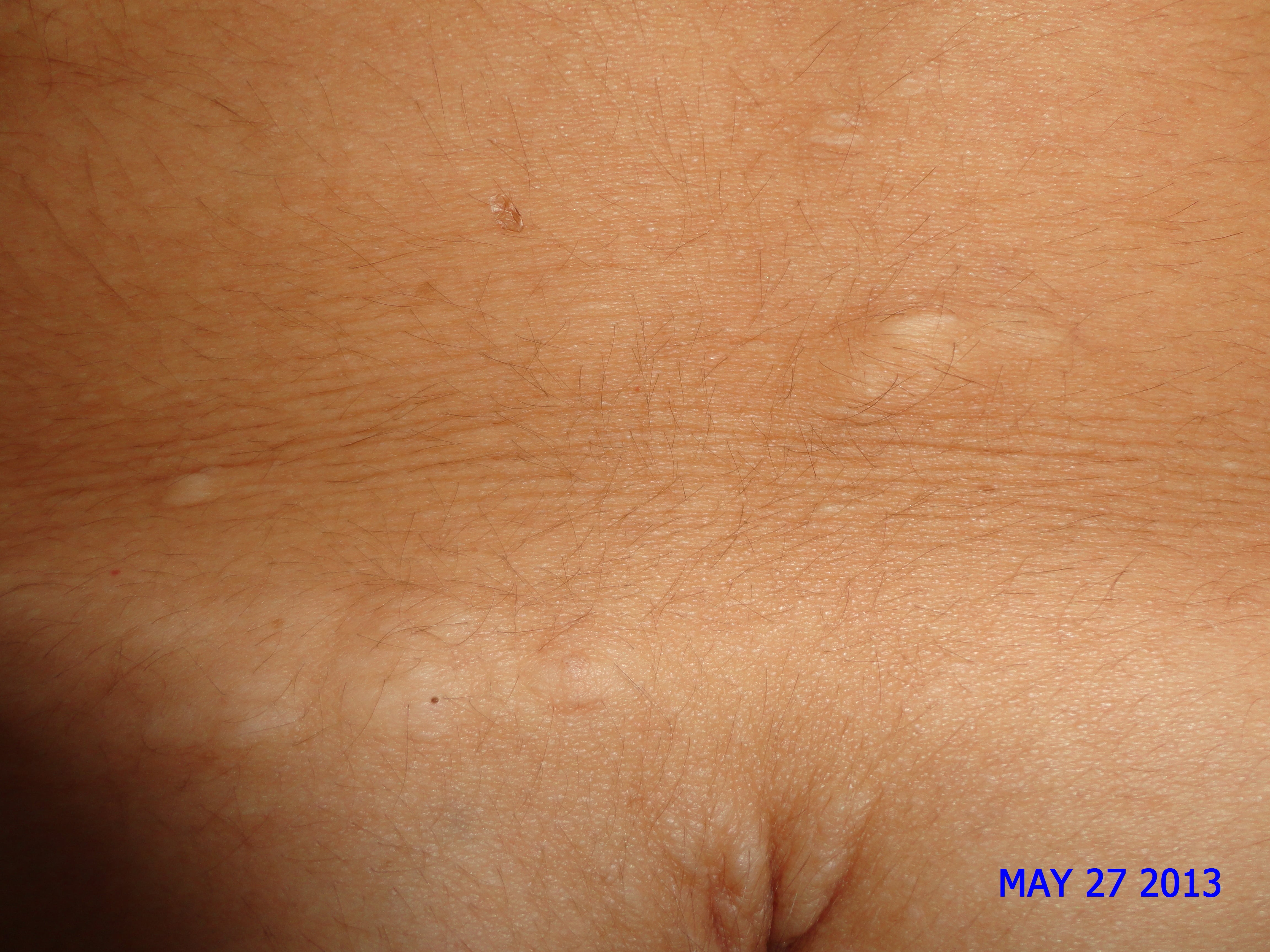 ESCLEROSIS TUBEROSA - PIEL CHAGRIN