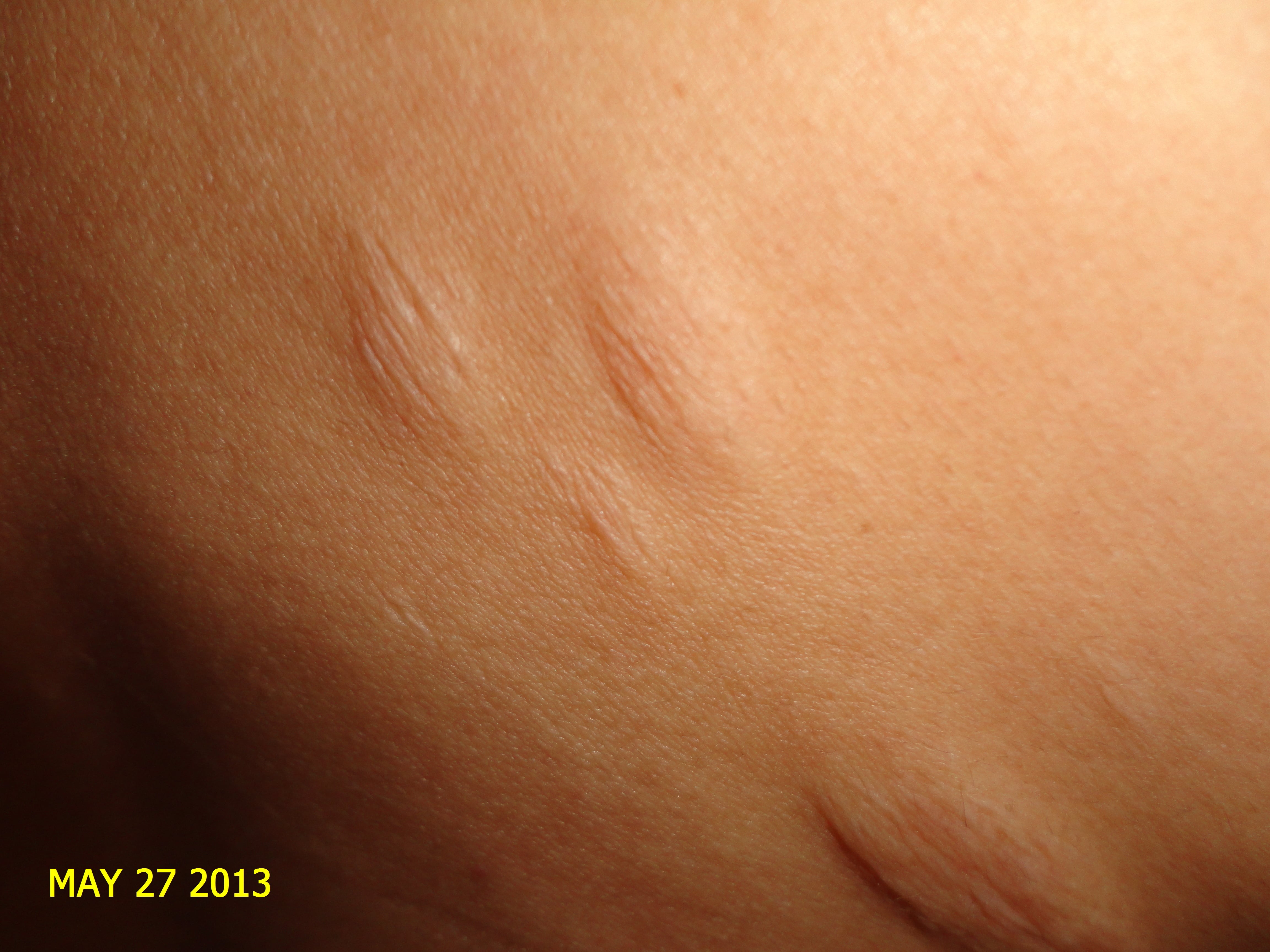 ESCLEROSIS TUBEROSA - PIEL CHAGRIN