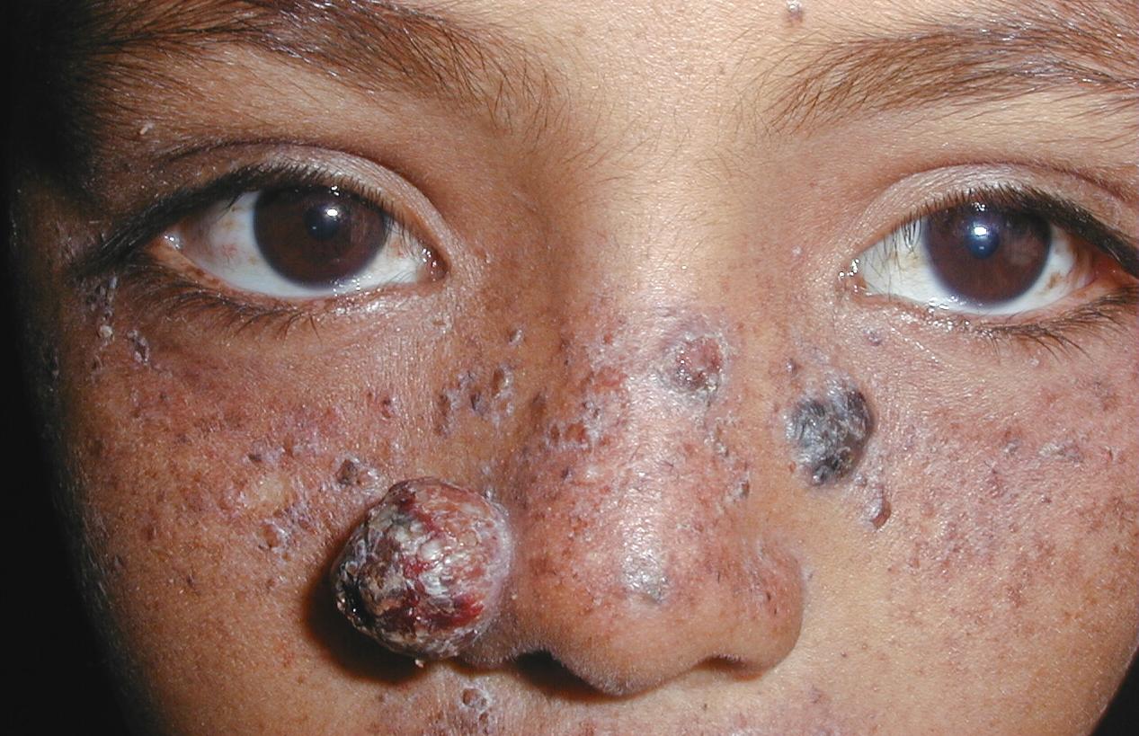 XERODERMA PIGMENTOSO