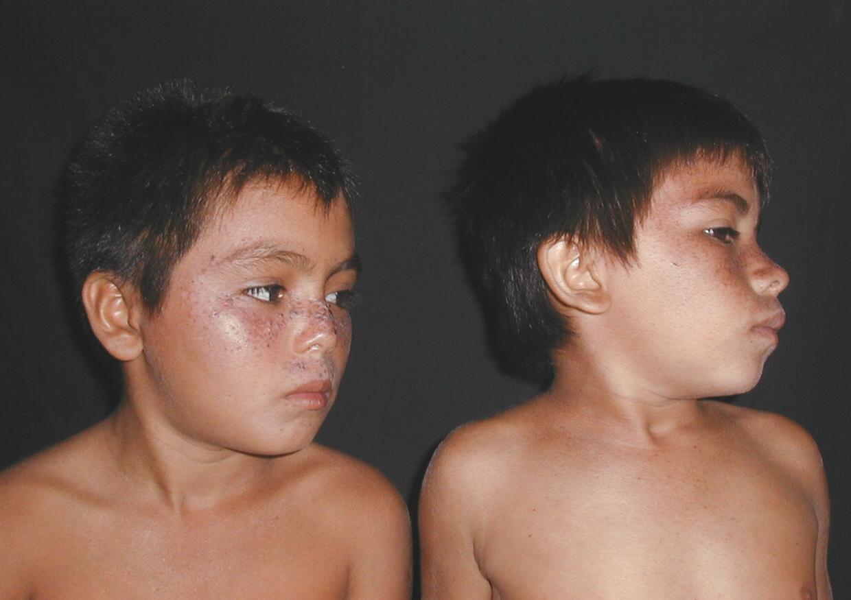 XERODERMA PIGMENTOSO - HERMANOS