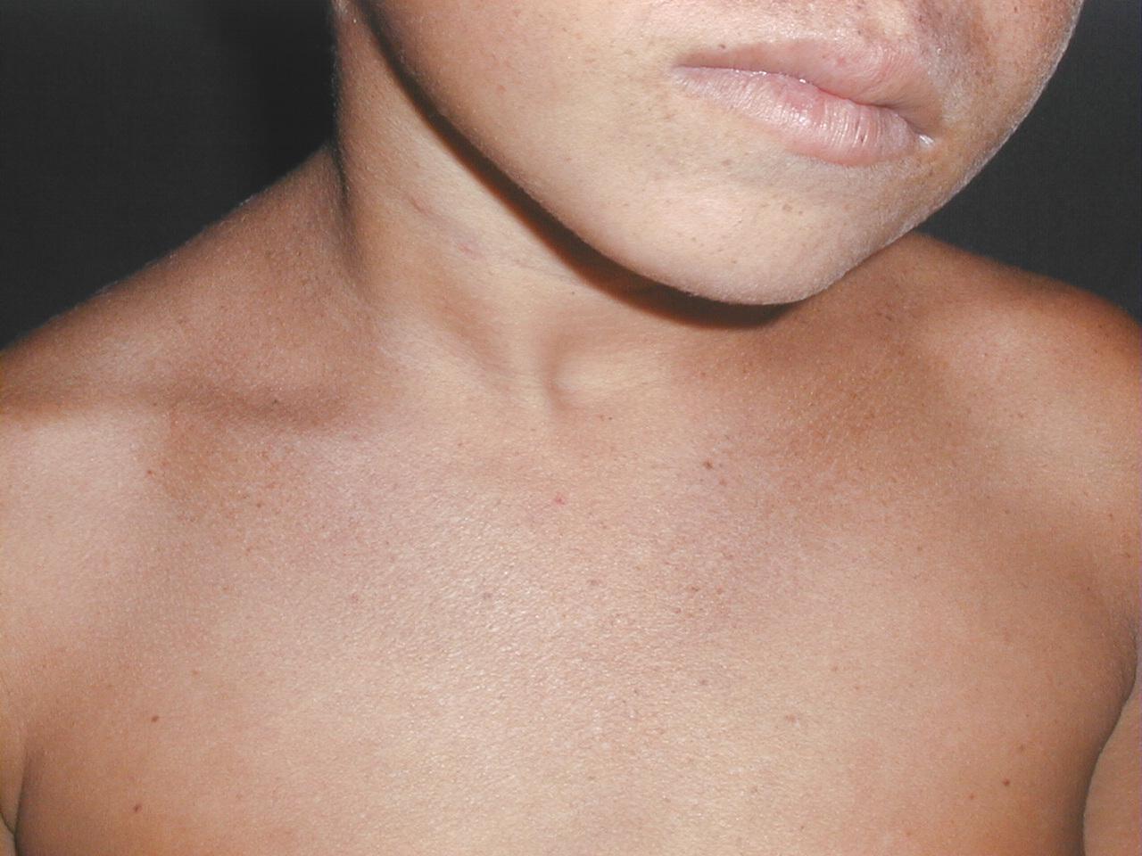 XERODERMA PIGMENTOSO - HERMANOS