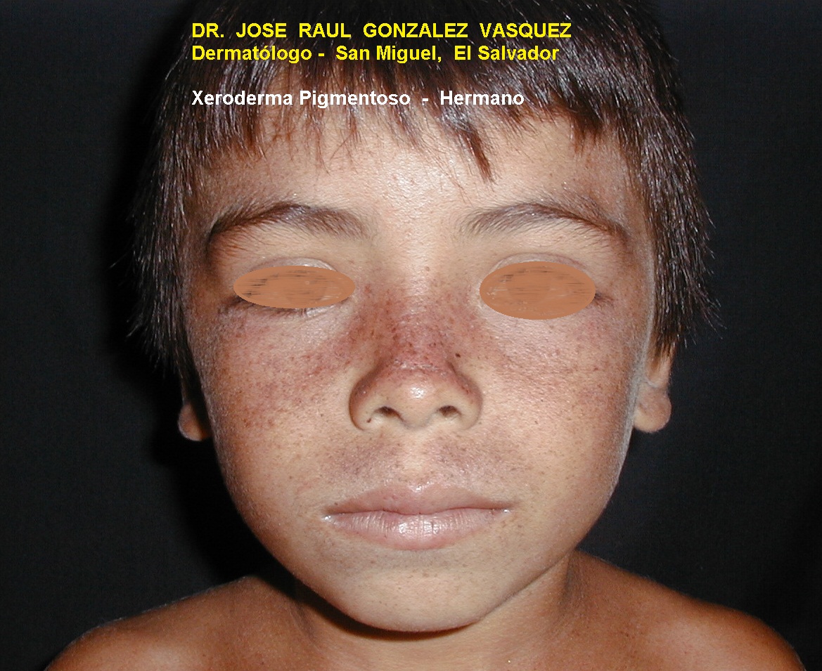 XERODERMA PIGMENTOSO - HERMANOS