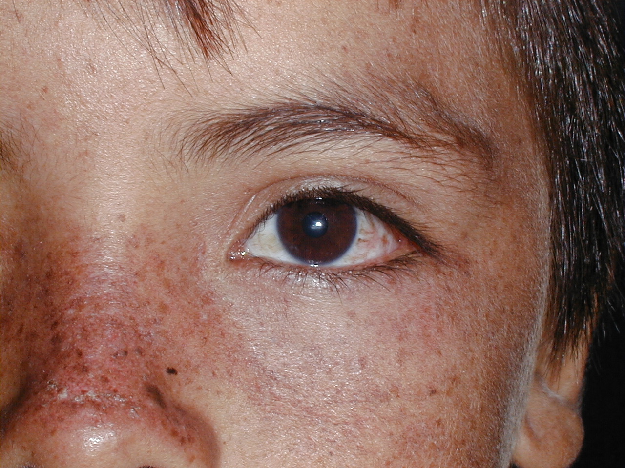 XERODERMA PIGMENTOSO - HERMANOS