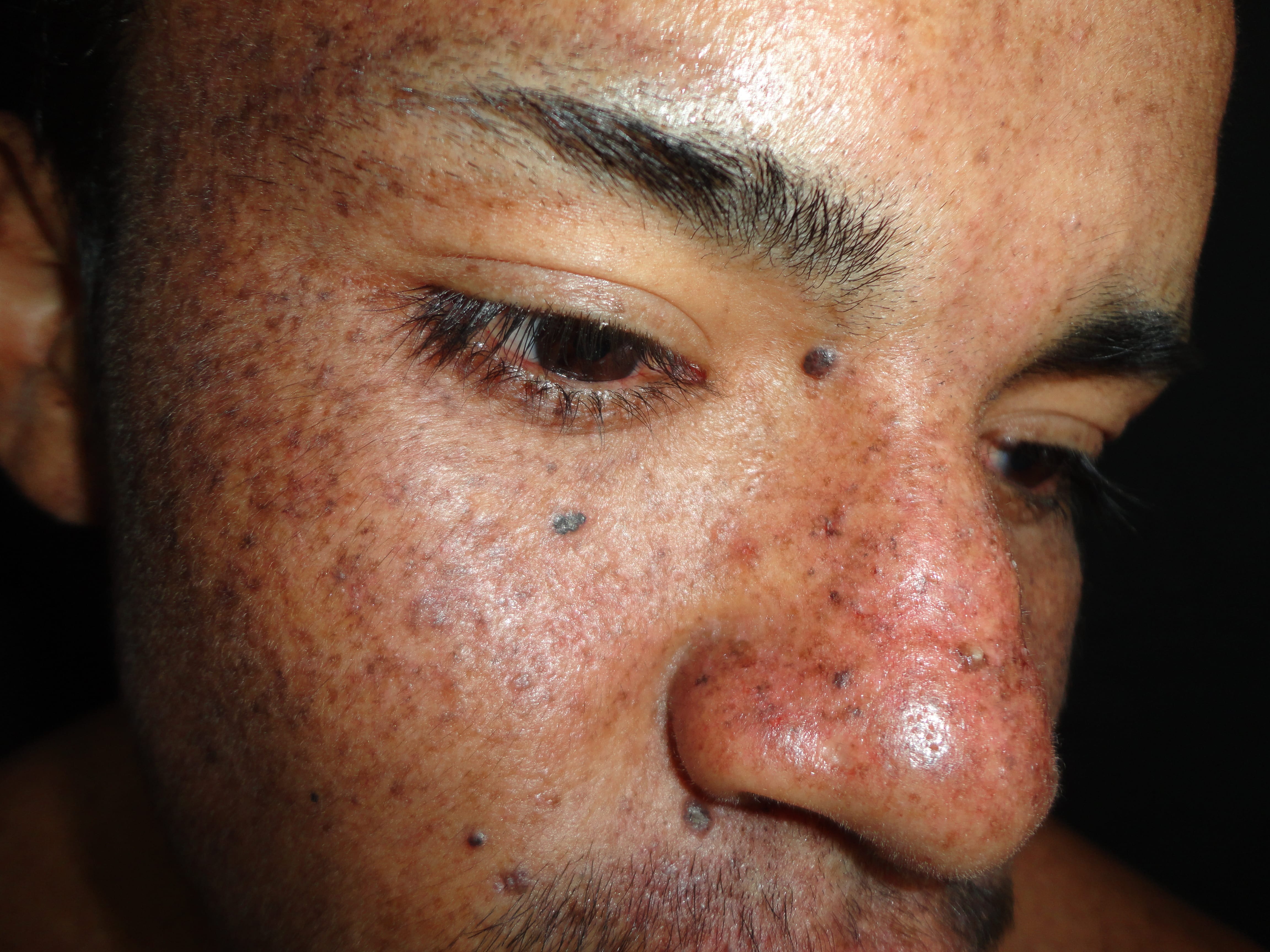 XERODERMA PIGMENTOSO