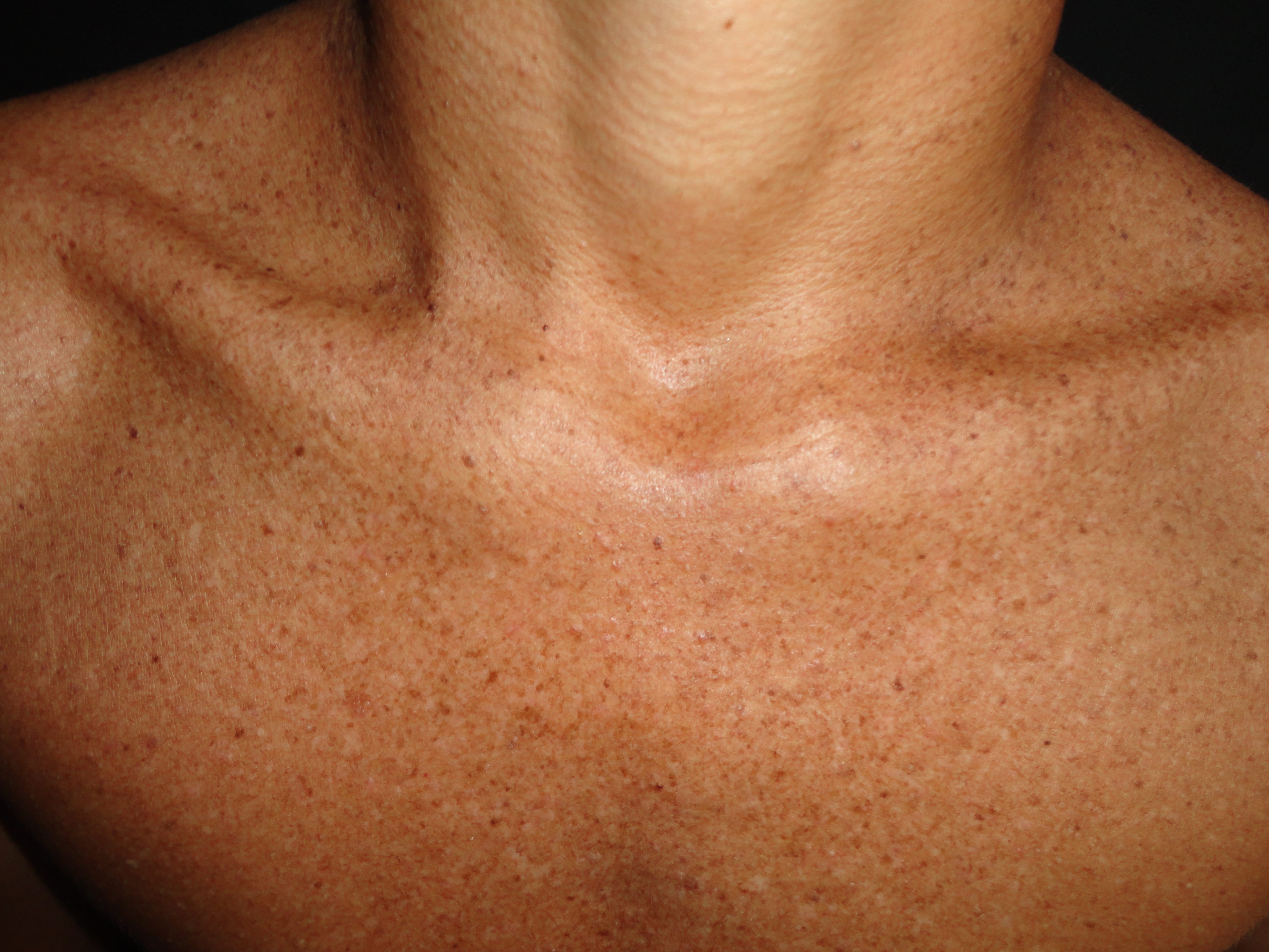 XERODERMA PIGMENTOSO